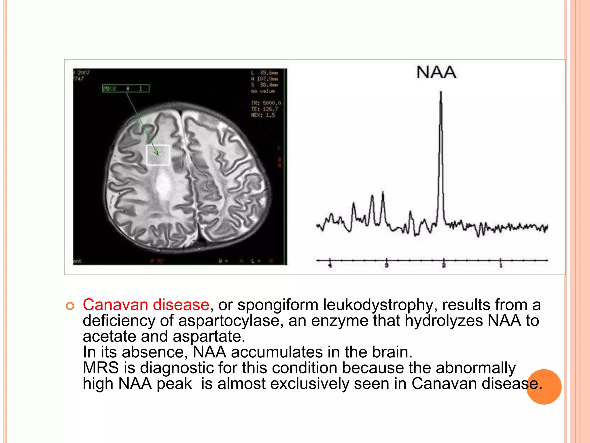  Canavan disease, or spongiform leukodystrophy, results from a
deficiency of aspartocylase, an enzyme that hydrolyzes NAA to
acetate and aspartate.
In its absence, NAA accumulates in the brain.
MRS is diagnostic for this condition because the abnormally
high NAA peak is almost exclusively seen in Canavan disease.
 