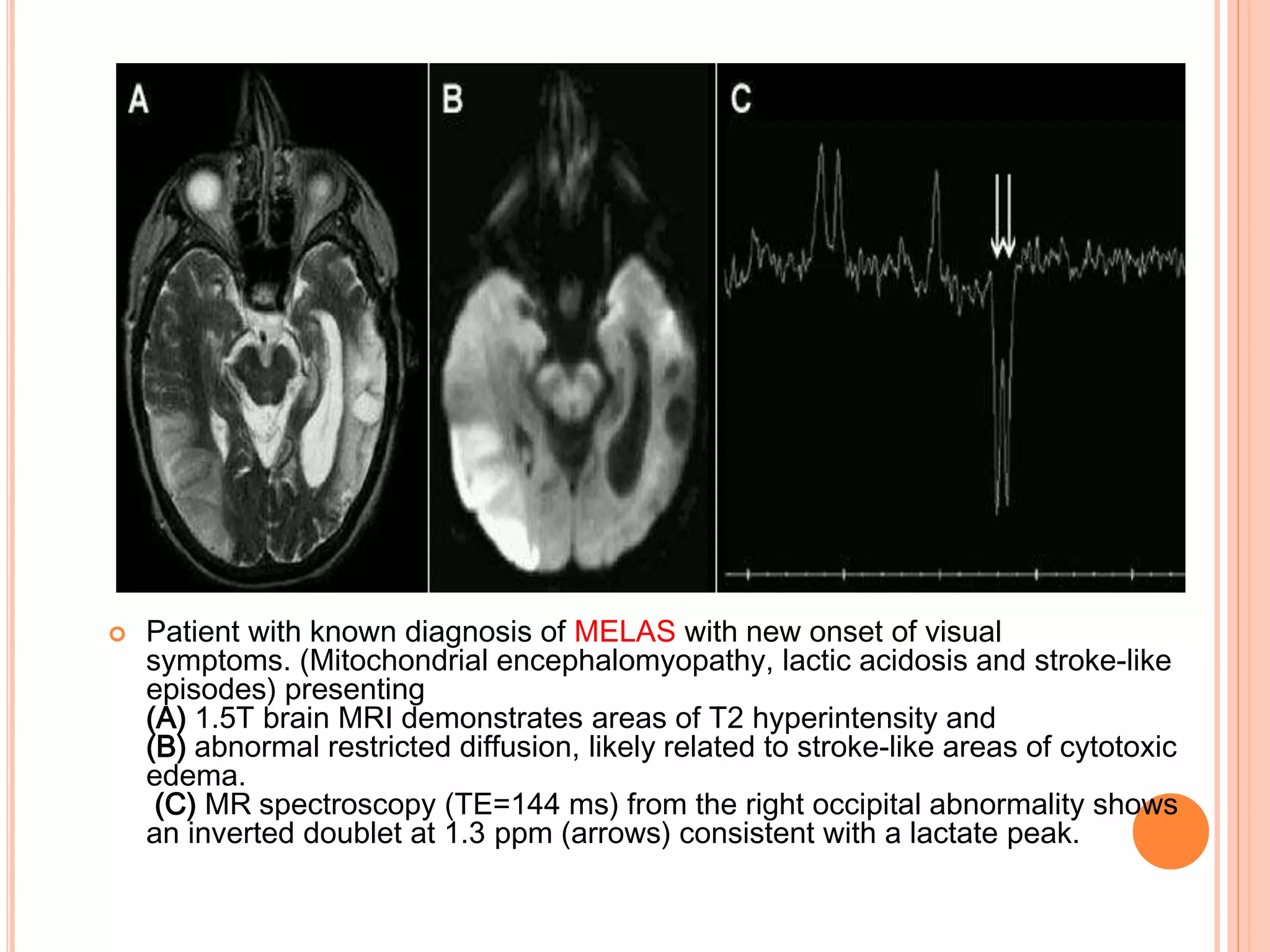  Patient with known diagnosis of MELAS with new onset of visual
symptoms. (Mitochondrial encephalomyopathy, lactic acidosis and stroke-like
episodes) presenting
(A) 1.5T brain MRI demonstrates areas of T2 hyperintensity and
(B) abnormal restricted diffusion, likely related to stroke-like areas of cytotoxic
edema.
(C) MR spectroscopy (TE=144 ms) from the right occipital abnormality shows
an inverted doublet at 1.3 ppm (arrows) consistent with a lactate peak.
 
