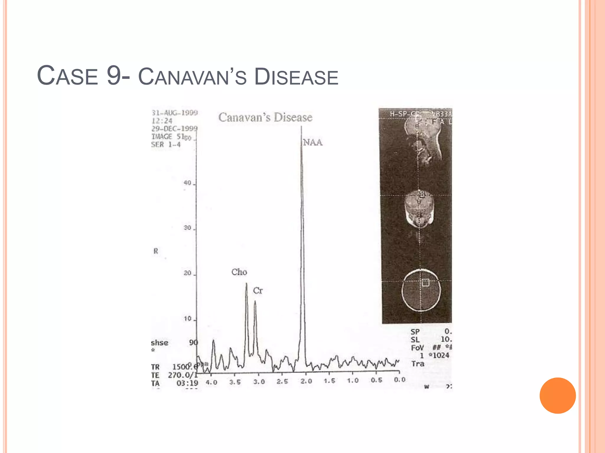 CASE 9- CANAVAN’S DISEASE
 