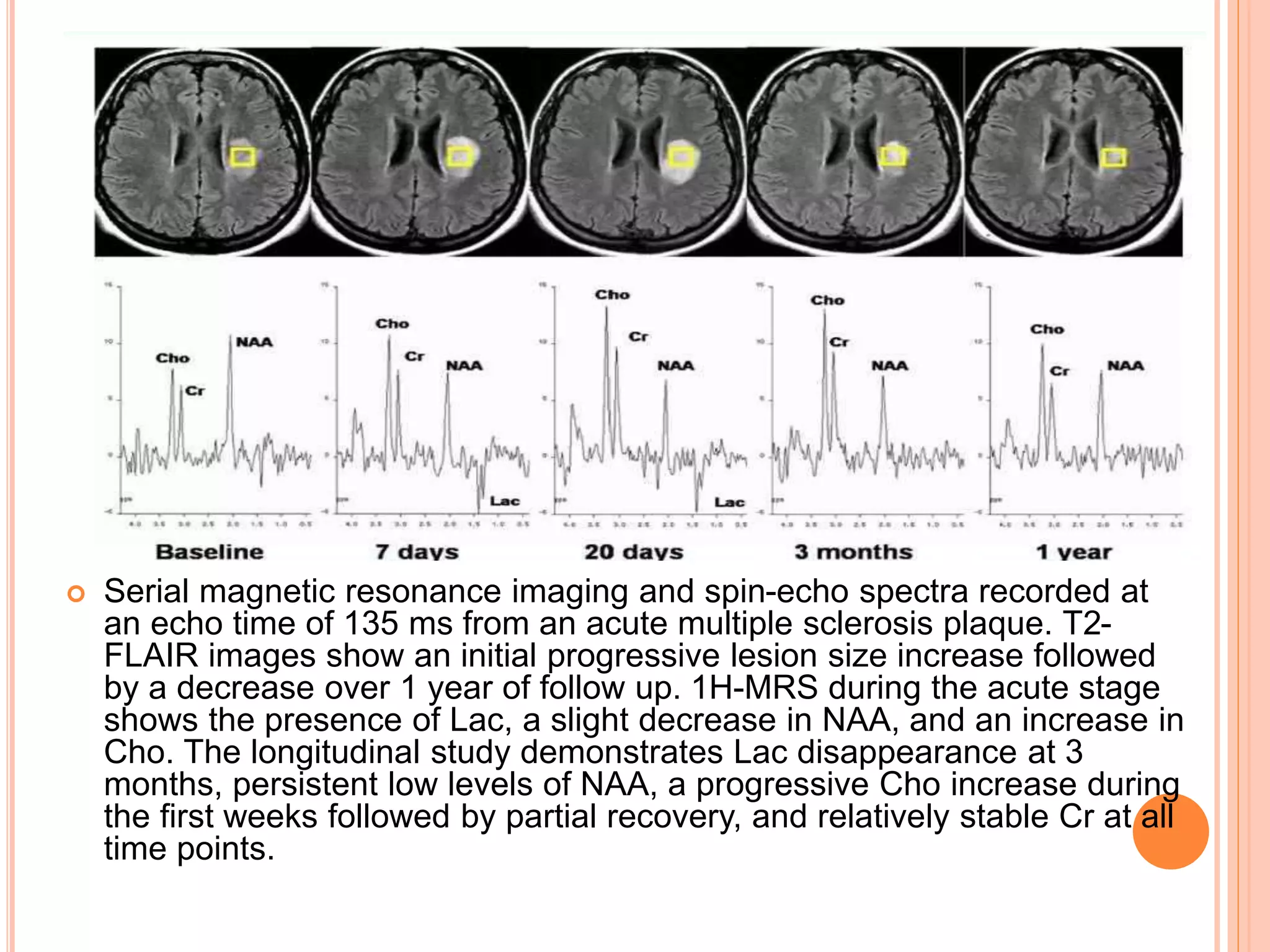  Serial magnetic resonance imaging and spin-echo spectra recorded at
an echo time of 135 ms from an acute multiple sclerosis plaque. T2-
FLAIR images show an initial progressive lesion size increase followed
by a decrease over 1 year of follow up. 1H-MRS during the acute stage
shows the presence of Lac, a slight decrease in NAA, and an increase in
Cho. The longitudinal study demonstrates Lac disappearance at 3
months, persistent low levels of NAA, a progressive Cho increase during
the first weeks followed by partial recovery, and relatively stable Cr at all
time points.
 