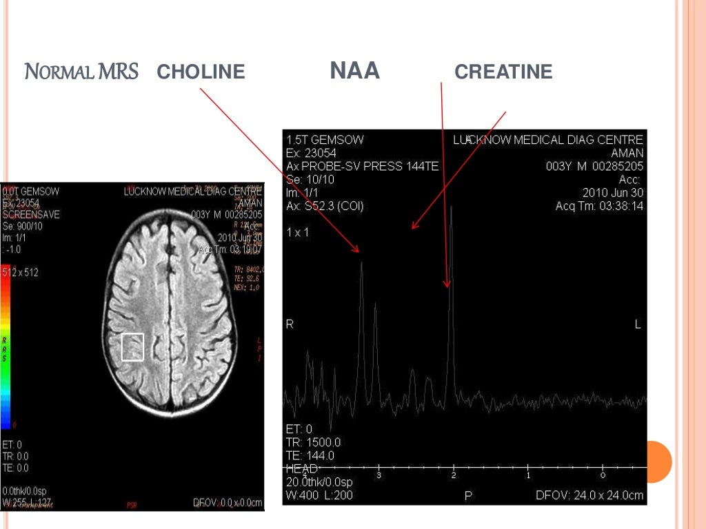 Magnetic Resonance Spectroscopy