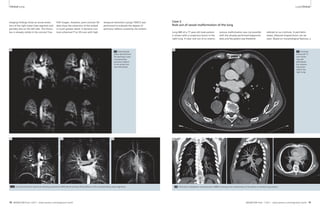 Clinical Lung Lung Clinical 
referred to our institute. A well delin-eated, 
ellipsoid shaped lesion can be 
seen. Based on morphological features, a 
2A Contrast 
enhanced CT 
scan show-ing 
well 
delineated 
but enhanc-ing 
lesion 
within the 
right lung. 
temporal resolution (syngo TWIST) was 
performed to evaluate the degree of 
perfusion defects caused by the emboli. 
1H Parenchymal 
phase derived from 
the perfusion scan; 
corresponding 
perfusion defects 
to the emboli are 
well delineated. 
Imaging findings show an acute embo-lism 
partially also on the left side. The throm-bus 
1H 
of the right lower lobe segment and 
is already visible in the coronal True- 
FISP images. However, post-contrast 3D 
data show the extension of the emboli 
in much greater detail. A dynamic con-trast 
enhanced T1w 3D scan with high 
1I 1J 1K 
Case 2 
Rule out of vessel malformation of the lung 
Lung MRI of a 77-year-old male patient 
is shown with a suspicious lesion in the 
right lung. A clear rule out of an arterio- 
venous malformation was not possible 
with the already performed diagnostic 
tests and the patient was therefore 
2B Thick-slice multiplanar reconstruction (MPR) showing close relationship of the lesion to arterial lung vessels. 
2A 
1I–K Coronal thick-slice maximum intensity projections (MIP) demonstrating filling defects of the corresponding vessel segments. 
2B 
18 MAGNETOM Flash 1/2011 · www.siemens.com/magnetom-world MAGNETOM Flash · 1/2011 · www.siemens.com/magnetom-world 19 
 
