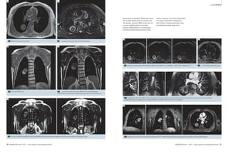 Clinical Cardiovascular 
Lung Lung Clinical 
2E 2F 
2G 
20 MAGNETOM Flash 1/2011 · www.siemens.com/magnetom-world 
2I 
MAGNETOM Flash · 1/2011 · www.siemens.com/magnetom-world 21 
2C Native transversal T1w MRI, … 
hamartoma is possible. While the tumor 
has a close relationship to several arte-rial 
vessels, dynamic MRI could rule out 
a vessel malformation (no arterio-venous 
malformation, no aneurysm). 
Contrast-media enhancement of the 
2D … corresponding T2w TSE with fat saturation. 
2E Coronal HASTE and … 2F … coronal T2w TSE showing different but well delineated 
components of the tumor, supporting the suspicion of hamartoma. 
2G Coronal TrueFISP acquired during free-breathing demonstrating free degree of movement during the breathing cycle. 
2H 
2H Original b-value images derived from DWI exam (right b = 0, middle b = 400, left b = 800 s/mm2), … 2I … Liecorresponding ADC map. 
2J 
2J Multiplanar thick-slice MIP of late-arterial dynamic scan showing relationship to arterial vessels and contrast-media enhancement 
as potential sign of malignancy; no imaging feature of AVM / aneurysm can be visualized. 
2K Multiplanar reconstruction based on late-phase 3D T1w VIBE demonstrating inhomogenous but evident contrast enhancement. 
2K 
2C 2D 
lesion, however, has to be interpreted 
as a sign of potential malignancy 
and further invasive evaluation was 
warranted (surgical resection). 
 