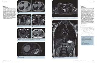 3A 4A 
Clinical Lung Lung Clinical 
Case 3 
Pneumonia 
A 66-year-old male volunteer was diag-nosed 
with pneumonia a few days previ-ously. 
This case clearly shows the poten-tial 
of MRI to detect and evaluate inflam-matory 
processes of the lung. In addi-tion 
to the pneumonia of the left lower 
lobe, a slight apical effusion and reactive 
mediastinal / hiliar lymphadenopathy 
(not shown) is present. No signs of 
malignancy and / or masking of lesions 
by the infiltrate can be found. 
3A Native low-dose CT of the lung. 
3B 3C 
3B Coronal HASTE. 3C Corresponding T2w TSE. 
3D 
3D Coronal TrueFISP at a different slice position 
showing additional apical pleural effusion. 
3E 
3E Native T1-weighted image. 
3F 
Case 4 
Sarcoidosis 
This 25-year-old woman underwent MRI 
for the follow-up of a proven sarcoidosis. 
The protocol was adapted to also evalu-ate 
the supraclavicular and nuchal lymph 
node stages, which were unsuspicious 
(therefore not shown). Best visualized by 
fat-saturated T2w MRI, however, multi-ple 
mediastinal and hiliar lymph nodes 
are visible. The lung parenchyma is nor-mal 
and no pleural effusions can be 
seen. However, a reduction of the degree 
of bihiliar lymphadenopathy was diag-nosed 
compared to CT and in accor-dance 
with clinical parameters, recurrent 
inflammation of the sarcoidosis stage 1 
was concluded. 
4B 
Conclusion 
This short case series shows that MRI 
of the lung is capable of assisting in the 
detection and diagnosis of a large range 
of lung pathologies. With growing expe-rience 
in the application of MRI in the 
lung, it can play an important role in 
future diagnostic set-up of lung patholo-gies, 
especially in younger patients. 
Contact 
Prof. Dr. med. Jürgen Biederer, MD 
Department of Diagnostic Radiology 
University Hospital Schleswig-Holstein, 
Campus Kiel 
Arnold-Heller-Street 3, Haus 23 
24105 Kiel 
Germany 
Phone: + 49 431-597-3153 
juergen.biederer@rad.uni-kiel.de 
4A Transversal T2w TSE with fat saturation showing bihiliar lymphadenopathy. 
4B Coronal T2w TSE (BLADE technique). 
3F Corresponding T2-weighted TSE with fat saturation at comparable height of the lung to the 
CT images in figure 3A. 
22 MAGNETOM Flash 1/2011 · www.siemens.com/magnetom-world MAGNETOM Flash · 1/2011 · www.siemens.com/magnetom-world 23 
 