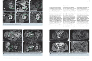 4A 4B 4C 
Clinical Cardiovascular 
T2 TSE fs 
VIBE arterial 
DWI – ADC 
VIBE venous 
4E 
4F 
4 Histologically proven carcinoma of the cyst wall which can only be appreciated in the ADC map where a local restriction of the diffusion can be seen. 
The contrast-enhanced studies do not allow a delineation of this lesion. 
5B 6B 
Skyra DWI – ADV 
Skyra 
TimTrio DWI – ADC TimTrio 
26 MAGNETOM Flash 1/2011 · www.siemens.com/magnetom-world 
Clinical 
User interface 
The MAGNETOM Skyra is equipped 
with a new software platform, syngo MR 
D11 (current version D) that has pro-vided 
technologists with several positive 
changes. The MR D11 platform is based 
on the well-known MR B and MR A 
syngo versions running on all current 
Siemens MR scanners and hosts various 
features. The user interface (UI) has 
been graphically overhauled with 
unchanged syngo functionality so that 
clinical and research users familiar with 
syngo can immediately start working. 
Beyond the visible changes in the 
UI, further technical improvements have 
been implemented that aim mainly at 
facilitating and accelerating the actual 
process of image acquisition. Some 
well-known features of syngo such as 
AutoCoilSelect have been extended to 
now include AutoPosition and auto-mated 
localizers. Based on the registra-tion 
of the patient (height/weight) and 
the body part/exam chosen for the 
examination the Skyra can automatically 
start the acquisition and hence save 
time and – furthermore – unnecessary 
mouse clicks. The most powerful new 
tools, however, are the so called Dot 
(Day optimizing throughput) engines. 
The Dot engines represent a complete 
customizable system of automatization, 
standardization and guidance for 
technologists. In neuro-imaging, for 
example, the Dot engine automatically 
aligns the images and chooses the 
appropriate FOV. Based on the examina-tion 
strategies as defined by the user, 
different protocols will be employed: 
a standard head exam, an exam based 
on BLADE sequences in the case of 
non-cooperative patients or dedicated 
sequences in case of a special exam 
focus. In cardiac imaging the Dot 
2 mm thin venous-phase VIBE 
thin MIP venous-phase VIBE 
MAGNETOM Flash · 1/2011 · www.siemens.com/magnetom-world 27 
Clinical 
arterial VIBE 
5 Intraindividual comparison study acquired at the 3T MAGNETOM Trio with Tim (lower row) and the 3T MAGNETOM Skyra (upper row, 6 months 
later). A hypervascular mass can be clearly seen on both arterial phase VIBE images while only the DWI-imaging acquired at the Skyra allows charac-terizing 
the mass. Surgery revealed a gastrointestinal stromal tumor (GIST). 
arterial VIBE 
VIBE non-enhanced 
VIBE delayed 
decrease patients’ anxiety. So far, not 
a single patient declined an examina-tion 
in the Skyra due to claustrophobia, 
which is particularly important for 
patients in longitudinal research stud-ies. 
In contrast, a whole new group of 
patients could be acquired in the mean-time: 
claustrophobic patients and obese 
patients who could only be examined 
in low-field open 1T scanners. Approxi-mately 
25% of all patients currently 
examined on the Skyra belong to this 
latter group. A further potential benefit 
of the system which has not been fully 
exploited so far is the imaging of anes-thetized 
patients requiring close medical 
surveillance. The open and wide bore 
enables an easy surveillance of the 
patient with the potential for, e.g., opti-mal 
access to a respiratory tube. 
T2 HASTE fat-sat 
DWI–ADC 
6 Long-segment inflammatory changes in the entire colon of a patient suffering from ulcerative colitis. Bowel wall thickening can be seen in the 
T2w-images as well as in the T1w-images post contrast but also in the DWI-sequence where a restriction of the diffusion can clearly be seen. Please 
note the normal appearance of the small bowel. 
4D 
5A 6A 
5C 6C 
5D 6D 
 