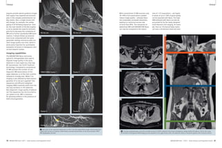 7A 7B 
Clinical Clinical 
PD fat-sat PD fat-sat 
7C 
TWIST-MRA frame 1 
7E 
frame 3 
7G 
frame 5 
7D 
frame 2 
7F 
frame 4 
7 Bony spur of the calcaneus barely seen on the 2 mm thin sagital PDw-images (small arrow) but 
clearly seen as focus of intense, inflammatory contrast enhancement in the time-resolved TWIST 
MR angiography (arrows). 
With conventional 3T MR-scanners only 
30–40% of all examinations yielded 
robust image quality – whereas Skyra 
has sustainably increased robustness, 
leading to a technical success rate 
of more than 85%. The robustness of 
abdominal DWI with MAGNETOM Skyra 
can now be compared to the robust-ness 
of 1.5T acquisitions – yet higher 
b-values of up to 1200 of good quality 
can be acquired with Skyra. The high 
SNR achieved with Skyra can also be 
accounted for by the newly designed 
multi-element coils ranging, for exam-ple, 
from an 18-channel body matrix 
coil over a 20-element head and neck 
8A 8D 
8B 
8C 
8 Coronal composed large z-axis (45 cm) field-of-view T2-HASTE sequence that shows homogenous image quality throughout. Due to the 2-way 
RF-excitation homogenous DWI-imaging can be acquired in the upper thorax (red), the abdomen (blue) or the pelvis (green) with minimal artifacts. 
engines provide special guidance images 
that support less experienced technolo-gists 
in the complex positioning for car-diac 
exams. Also, a single mouse click 
will change, for example, the cardiac 
gating of all following sequences. Over-all, 
the main benefit of the Dot engines 
is not to obviate the need for technolo-gists 
but to decrease the complexity of 
MR and to further standardize MR-exam-inations. 
It allows follow-up examina-tions 
to be conducted with the same 
parameter settings and hence with con-stant 
image quality over time, which is 
particularly important for quantitative 
evaluation of lesions in therapeutic clini-cal 
and research studies. 
Imaging capabilities 
The MAGNETOM Skyra overcomes 
typical B1-imhogeneities that used to 
degrade image quality in the spine, 
abdomen or neck region by a two-way 
RF-transmission, the TimTX TrueForm 
technology. Compared to conventional 
3T MR-scanners the number of non-diagnostic 
MR-examinations of the 
upper abdomen or of the neck could be 
reduced to virtually zero. While T1w-imaging 
is less affected by field inhomo-geneities 
(if no fat-sat is applied) T2w-sequences 
and diffusion-weighted 
imaging (DWI) massively profit from the 
two-way excitation in the abdomen. 
Non-diagnostic image quality of abdomi-nal 
T2w-sequences has not occurred on 
our system so far. DWI is notorious 
for ghosting artifacts in the presence of 
field inhomogeneities. 
28 MAGNETOM Flash 1/2011 · www.siemens.com/magnetom-world MAGNETOM Flash · 1/2011 · www.siemens.com/magnetom-world 29 
 