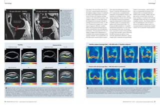 Technology Technology 
mercially in the near future. The 0.23 x 
0.23 mm2 in-plane spatial resolution of 
the sagittal images in Figure 3 is sufficient 
for direct visual appreciation of the dif-fusely 
thinned and irregular cartilage 
surface in the osteoarthritic patient. The 
images in Figure 4, on the other hand, 
are targeted to microscopic changes in 
cartilage structure and function. In addi-tion 
to anatomical images and T2 maps, 
maps of apparent diffusion constant 
(ADC) and fractional anistropy (FA) are 
shown, derived from line-scan diffusion 
acquisitions. The decreased FA in the car-tilage 
of subjects with osteoarthritis is 
consistent with structural damage to the 
collagen network. The increased ADC, on 
the other hand, may be shown to result 
from reduced proteoglycan content. 
Figure 5 illustrates the potential value 
of 7T scanning for a complementary 
evaluation of proteoglycan content, and 
therefore of cartilage function. These 
images represent various slices through 
3D volumetric sodium concentration 
maps encompassing the whole knee in 
a healthy subject as compared with a 
patient with osteoarthritis (OA). The 
enhanced SNR available at 7T enabled 
whole-knee acquisitions at 2 mm isotro-pic 
resolution in less than 15 minutes. 
Such acquisitions would not be possible 
at lower field strengths, given inherently 
low MR sensitivity to sodium nuclei. 
Through appropriate calibration, sodium 
images were converted into quantitative 
Healthy subject (average [Na] ~ 240-280 mM in 5 healthy subjects) 
5B 5C 5D 
Patient with OA (average [Na] ~ 180-240 mM in 5 patients) 
5A 
sodium concentrations, which may be 
seen to be generally decreased in the 
osteoarthritic as compared with the 
healthy knee cartilage. Indeed, the aver-age 
sodium concentration across the 
knee cartilage in 5 patients with OA was 
noticeably lower than that in a group of 
5 healthy controls. This change reflects a 
loss of proteoglycans, the removal of 
whose net negative charge results in a 
corresponding loss of positively-charged 
sodium ions to preserve charge balance. 
5E 5F 5G 5H 
5 7T sodium imaging of cartilage in a healthy subject (top) and a patient with osteoarthritis (bottom). 7T field strength enabled whole-knee 
3D volumetric sodium concentration maps at comparatively high resolution in less than 15 minutes. Note reductions in average sodium 
concentration in arthritic versus healthy cartilage, both in the individual knees shown and in ensembles of 5 patients and 5 controls. 
(Undersampled 3D radial pulse sequence, TR/TE 80/0.2 ms, 2.0 x 2.0 x 2.0 mm3, single-tuned quadrature sodium coil custom-designed in 
collaboration with Rapid Biomedical, GmbH. Images courtesy of Ravi Regatte, Ph.D., Department of Radiology, NYULMC, USA.) 
3 The high spatial reso-lution 
available at 7T 
enables visualization of 
the diffusely thinned 
irregular cartilage sur-face 
in a patient with 
osteoarthritis (right), as 
compared with an age-matched 
healthy subject 
(left). (Fat-suppressed 3D 
FLASH, TR/TE 26/5.1 ms, 
0.23 x 0.23 x 1 mm3, 60 
partitions, acquisition 
time 6:58 min, transmit-receive 
7T knee coil array 
with 28 receive elements 
from QED. Images cour-tesy 
of Gregory Chang, 
M.D., Department of 
Radiology, NYULMC, 
USA). 
3A 
55-year-old male – Healthy 
Normal thickness 
Smooth surface 
51-year-old male – Osteoarthritis 
Diffusely thinned 
Irregular surface 
3B 
Healthy Osteoarthritis 
Anatomical image T2 (ms) Anatomical image T2 (ms) 
4A 
4B 
0 35 0 35 
ADC (10-3mm2/s) FA ADC (10-3mm2/s) FA 
4C 4D 
4E 4F 
4G 4H 
0 2.5 0 1 0 2.5 0 1 
4 Apparent diffusion constant (ADC) and fractional anisotropy (FA) maps derived from line-scan diffusion acquisitions (bottom row) juxtaposed 
to anatomical images and T2 maps in the knees of a healthy adult subject (left) and a patient with osteoarthritis (right). Increased ADC and 
decreased FA are seen in diseased tissue, reflecting microscopic changes in the fiber structure of the cartilage. (Line Scan Diffusion Tensor 
Imaging sequence: TE/TR/TReff 46/180/2890 ms, 0.6 x 0.6 x 2 mm3, 5 slices, b-values 5, 450 s/mm2, 6 directions, fat-saturation, acquisition time 
14:00 min; Anatomical images: T2*-weighted fat-saturated GRE, TE/TR 9.2/40 ms, 0.5 x 0.5 x 0.5 mm2, acquisition time 10:00 min; T2-mapping 
acquisitions: multi-slice 2D multi-echo fat-saturated sequence with stimulated echo suppression, TE/TR 16/3500 ms, 0.6 x 0.6 x 2 mm3, 5 slices, echo 
train length 8, acquisition time 13:35 min. QED 28-element 7T knee array used in all cases. Images courtesy of Jose Raya, Ph.D., NYULMC, USA.) 
34 MAGNETOM Flash 1/2011 · www.siemens.com/magnetom-world MAGNETOM Flash · 1/2011 · www.siemens.com/magnetom-world 35 
350 
300 
250 
200 
150 
100 
50 
0 
350 
300 
250 
200 
150 
100 
50 
0 
 