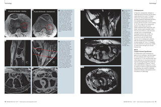 Technology Technology 
Osteoporosis 
In Figure 6, osteoporotic changes in 
trabecular bone structure may be appre-ciated 
directly from axial 7T images, 
rather than being probed indirectly 
through projection-based densitometry. 
This enables assessment not only 
of bone density but also of bone quality 
[3, 4]. The image of the osteoporotic 
patient shows fewer and more 
widely-separated dark trabeculae with 
larger marrow spaces between them. 
This structure reflects a reduced bone 
strength and a correspondingly 
increased fracture risk. In fact, it is 
believed that bone density alone 
accounts for only 50–60% of the 
fracture risk in osteoporotic patients, 
with the remaining risk attributable 
to bone quality [3]. Thus, 7T imaging 
has the potential to improve our ability 
to assess bone strength and clinical 
fracture risk. 
6 Images of the distal femur 
of a healthy subject (left) and 
a patient with osteoporosis 
(right). Note the reduction in 
density of trabecular bone 
structure in the patient as 
compared with the control 
(for example, in the circled 
regions of interest). (3D 
FLASH, TR/TE 20/5.1ms, 0.23 
x 0.23 x 1.0 mm3, 80 parti-tions, 
acquisition time 7:09 
min, QED 28-element knee 
coil array. Images courtesy of 
Gregory Chang, M.D., Depart-ment 
of Radiology, NYULMC, 
USA.) 
6A 6B 
55-year-old female – Healthy 76-year-old female – Osteoporosis 
Wrist 
Carpal Tunnel Syndrome 
In collaboration with interested sur-geons 
at our institution, we have begun 
to study patients with Carpal Tunnel 
Syndrome at 7T. The resulting high-reso-lution 
depiction of structures surround-ing 
and running through the carpal tun-nel, 
as exemplified in Figures 7 and 8, 
will enable definitive diagnosis, as well 
as helping to define surgical approaches 
and allowing the creation of detailed 
anatomical atlases in the presence and 
the absence of pathology. 
7 Images from a 0.33 mm3 
isotropic 3D gradient-echo 
acquisition in a patient with 
Carpal Tunnel Syndrome. 
The red lines in the top right 
image indicate the image 
plane geometry of the bottom 
two images. The anatomy 
within the carpal tunnel is 
clearly delineated, and pro-nounced 
swelling of the 
median nerve may be appreci-ated. 
(3D FLASH, TR/TE 40/3.2 
ms, 0.33 x 0.33 x 0.33 mm3, 
128 partitions, acquisition 
time 7:10 min, custom-built 
8-element 7T extremity coil 
array. Images obtained as 
part of a collaboration with 
Dr. David Chiu, Department of 
Surgery, NYULMC, USA.) 
8 2D spin-echo 
images of a 
patient with Car-pal 
Tunnel Syn-drome. 
Individual 
fascicles of the 
inflamed median 
nerve can be 
tracked even 
through the con-striction 
at the 
carpal tunnel. 
(2D TSE, TR/TE 
5500/87 ms, 
0.2 x 0.2 x 1 mm3, 
13 slices, 
Turbo Factor 13, 
acqui-sition time 
3:35 min, custom-built 
8-element 
7T extremity coil 
array. Images 
obtained as part 
of a collaboration 
with Dr. David 
Chiu, Department 
of Surgery, 
NYULMC, USA.) 
7A 7B 
7C 7D 
8A 
8B 
8C 
36 MAGNETOM Flash 1/2011 · www.siemens.com/magnetom-world MAGNETOM Flash · 1/2011 · www.siemens.com/magnetom-world 37 
 