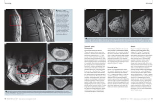 Technology Technology 
11A 11B 11C 
3T 
7T QED 7T NYU 
11 Comparison of 3T (left, In Vivo Corp. 4-element receive coil array) and 7T breast images (middle: QED 16-element coil array; right: NYU custom-designed 
2-element coil array). 7T images have significantly higher SNR for the same image resolution and total acquisition time. (3D GRE with Fat 
Saturation, TR/TE 4.37/1.92 ms, 0.6 x 0.6 x 0.6 mm3, 208 partitions, acquisition time 4:28 min. Images courtesy of Ryan Brown, Ph.D., NYULMC, USA.) 
Thoracic Spine 
Cavernoma 
Figure 9 documents the case of a 
19-year-old patient whose cavernous 
angioma at thoracic spinal level T5 was 
discovered incidentally on a 1.5T MR 
scan at another institution following a 
sporting accident. Subsequent 3T imag-ing 
was also performed in an attempt to 
determine the feasibility and advisability 
of surgery for this otherwise asymptom-atic 
young man, but image quality was 
insufficient to define the detailed inter-nal 
structure of the lesion and the sur-rounding 
spinal cord. The family came 
to our center in the hope that 7T imag-ing 
could further inform their decision 
and guide a potential surgical approach. 
A team of physicists, RF engineers, tech-nologists, 
neuroradiologists, and spinal 
surgeons was mobilized to address this 
challenging question. Figure 9 shows 
sagittal images at two magnifications 
highlighting the lesion. Using a custom-built 
8-channel transmit-receive 7T spine 
array [5] and optimized gradient-echo 
and spin-echo pulse sequences, nearby 
cord structure could be defined with 
unprecedented detail. Unfortunately, 
residual blood products in the vascular 
lesion resulted in susceptibility-related 
signal voids in the immediate vicinity of 
the lesion, preventing ideal delineation. 
Work is now underway to apply suscepti-bility- 
insensitive approaches for further 
improved visualization. This example 
highlights both the promise and some of 
the ongoing practical challenges associ-ated 
with clinical 7T studies. 
Cervical Spine 
Figure 10, on the other hand, shows 
the exquisite delineation of spinal cord 
substructure which may be achieved 
at 7T in regions not subject to high sus-ceptibility 
gradients. In these images, 
obtained with a 4-element transmit-receive 
C-spine coil array from Rapid Bio-medical, 
GmbH, excellent spatial detail is 
observed, differentiating gray/white mat-ter 
tissue, dorsal and ventral nerve roots, 
denticulate ligaments, dura mater, pia 
mater, and rostral-caudal blood vessels. 
Breast 
Figure 11 compares breast images 
obtained in the same healthy adult 
subject at 3T and at 7T. Substantial 
increases in SNR are evident for the 
same spatial resolution and total acquisi-tion 
time in the 7T images. 3T images 
were acquired using a commercially-available 
4-element receive-only 3T 
breast array from In Vivo Corp. 7T 
images were acquired both with a com-mercial 
transmit-receive breast coil array 
with 16 receive elements from QED and 
with a custom-designed 2-element 
transmit-receive breast array developed 
at our Center. Our custom-designed 7T 
coil array has also been used to charac-terize 
the distribution of T1 and T2 values 
and B0 field distribution in healthy breast 
tissue [6], in preparation for clinical 
studies to come. Some further develop-ment 
and pulse sequence optimization 
is called for to reap the full benefits of 
7T SNR enhancements, but 7T imaging 
may be expected to shift favorably the 
balance of spatial and temporal resolu-tion 
which is so crucial for characteriza-tion 
of breast cancer. 
9 Sagittal 7T images 
(left, full field-of-view; right, 
close-up of boxed area) of the 
spine of a 19 year-old male 
with a cavernous angioma at 
T5 discovered incidentally on 
earlier lower-field MR scans. 
Imaging at 7T improved 
spatial resolution and lesion 
visualization as compared 
with 1.5T and 3T scans, 
though certain details are still 
obscured by susceptibility 
artifacts from residual blood 
products. (2D TSE 0.55 x 0.55 
x 1.5 mm3, TR/TE 6000/10 ms, 
11 slices, acquisition time 
4:55 min, custom-built trans-mit- 
receive 7T spine array 
with 8 receive elements.) 
10A 10B 
10C 
10D 
C1 
C2 
C3 
10 High spatial resolution enables noninvasive visualization of spinal cord structure with unprecedented detail. (2D gradient echo, 0.18 x 0.18 x 
3.0 mm3, TR/TE 500/4.91 ms, 5 slices, 4 element transmit-receive C-spine array from Rapid Biomedical GmbH. Images courtesy of Eric Sigmund, Ph.D., 
Department of Radiology, NYULMC, USA.) 
9 
38 MAGNETOM Flash 1/2011 · www.siemens.com/magnetom-world MAGNETOM Flash · 1/2011 · www.siemens.com/magnetom-world 39 
 