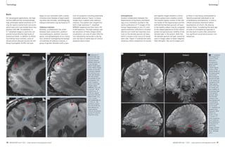 Technology Technology 
Brain 
For neurological applications, the high 
intrinsic SNR and the correspondingly 
high achievable spatial resolution at 7T 
may be used to resolve brain structures 
which have until now eluded direct visu-alization 
with MR. Susceptibility- or 
T2*-weighted images in particular can 
provide extraordinarily high levels of 
anatomical detail, in addition to afford-ing 
striking tissue contrast, some of 
whose precise physical sources are still 
being investigated. At NYU we have 
begun to scan volunteers with a variety 
of known brain diseases to begin explor-ing 
what new clinically- and biologically-relevant 
information may be found at 7T. 
Tuberous sclerosis 
Recently, a collaboration has arisen 
between basic researchers, pediatric 
neuroradiologists, pediatric neurosur-geons, 
and epileptologists at our institu-tion, 
aimed at investigating the biologi-cal 
substrate of tuberous sclerosis, a 
group of genetic disorders with a spec-trum 
of symptoms including potentially 
intractable seizures. Figure 12 shows 
images from a patient with tuberous 
sclerosis. This patient was imaged first 
with a high resolution T1-weighted 
MPRAGE sequence and then with a 3D 
FLAIR sequence. The high isotropic spa-tial 
resolution of these images allows 
visualization not only of tubers (like the 
one indicated by red arrows in the fig-ure), 
but also of subtle signs of cortical 
dysplasia (blue arrow). 
13 
MPRAGE FLAIR Control 
12 Depiction of 
cortical tuber (red 
arrows) at 7T with 
0.8 mm isotropic 
MPRAGE (left) and 
1 mm isotropic 
SPACE FLAIR (right). 
A thin ribbon of grey 
matter can be seen 
tracking in towards 
the ventricle in an 
axial view (bottom 
left, blue arrow) – 
an example of corti-cal 
dysplasia. The 
tuber is hyperin-tense 
in the FLAIR 
images (right). 
(MPRAGE, 0.8 x 0.8 
x 0.8 mm3, TR/ TE 
2250/3.8 ms, TI 
1100 ms, acquisi-tion 
time 5:30 min; 
SPACE-FLAIR, 1.0 x 
1.0 x 1.0 mm3, 
TR/ TE 8000/380 ms, 
TI 2100 ms, 160 
partitions, acquisi-tion 
time 9:39 min. 
Nova Medical Inc 
single-element 
transmit 24-element 
receive 7T close-fit-ting 
brain array.) 
as these is now being contemplated to 
identify prodromal individuals at risk 
of developing schizophrenia, in time to 
initiate preventive treatment before 
development of chronic life-altering 
mental illness. Considering the early age 
of onset of schizophrenia (typically in 
the late teens to early 20s), prevention 
has significant social and economic con-sequences. 
13 T2*-weighted 
GRE images of a 
normal control 
(left) and a 
schizophrenic 
patient (right). 
Notice the 
smooth regular 
contour of the 
inferior border of 
the hippocampus 
and the well-defined 
dentate 
granule cell layer 
in the control, as 
compared to the 
ridged appear-ance 
of the infe-rior 
border and 
poor visibility of 
the dentate layer 
in the patient 
(arrows). Note 
also the high 
contrast in the 
basal ganglia and 
in small blood 
vessels through-out 
the brain. 
(T2*-weighted 2D 
gradient-echo 
sequence, TR/TE 
944/25 ms, 
0.232 × 0.232 
×1.0 mm3, 17 
slices, acquisition 
time 14:00 min. 
Nova Medical Inc 
24-element 7T 
head array. 
Images courtesy 
of Oded Gonen, 
Ph.D., NYULMC, 
USA.) 
12A 12B 
12C 12D 
Schizophrenia 
Another collaboration between the 
Departments of Psychiatry and Radiol-ogy 
at our institution resulted in the 
recent publication of 7T images of the 
human hippocampus in vivo [7], with 
spatial resolution sufficient to visualize 
directly such small but important struc-tures 
as the dentate granule cell layer, 
which is known to be a locus of neural 
stem cells. Figure 13 extends this work, 
showing a direct comparison of coronal 
and sagittal images between a schizo-phrenic 
patient and a healthy control. 
The smooth regular contour of the infe-rior 
border of the hippocampus and the 
well-defined dentate granule cell layer 
in the healthy subject may be compared 
to the ridged appearance of the inferior 
border and general poor visibility of the 
dentate layer in the patient. Note that 
the dentate granule cell layer cannot be 
seen in images taken at lower magnetic 
field strengths. The use of images such 
Patient 
40 MAGNETOM Flash 1/2011 · www.siemens.com/magnetom-world MAGNETOM Flash · 1/2011 · www.siemens.com/magnetom-world 41 
 