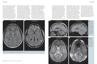 Technology Technology 
Standard FLAIR sequences are difficult to 
utilize at 7T because their inversion 
pulse and multiple refocusing pulses 
result in very high SAR. We have 
achieved similar image contrast to 3T 
FLAIR images with 2D sequences, but 
only with a limited number of slices in 
the standard scan time due to SAR 
restrictions. However, a Siemens works 
in progress (WIP) sequence is available 
based on the 3D SPACE sequence which 
provides FLAIR-like contrast. We run this 
at 1 mm isotropic resolution, and the 
scan time is roughly equivalent to the 
combined time taken for axial and sagit-tal 
FLAIR scans at 3T. The isotropic 7T 
data set can then be reformatted into 
any plane. With this set of parameters 
we are able to boost the transmitter ref-erence 
voltage again without exceeding 
the SAR limits, in this case to 350 volts. 
We compare 3T images with correspond-ing 
7T reformats in Figures 18–19. There 
are some differences in the contrast and 
image quality between the 3T and 7T 
scans, but with this new sequence we 
can add FLAIR contrast to our standard 
protocol at 7T. We have not yet evaluated 
whether the two approaches yield equiv-alent 
diagnostic information about brain 
lesions, but the 7T SPACE-FLAIR is a pow-erful 
addition to the array of sequences 
which can be run routinely at 7T. 
HemoFLASH is a 2D FLASH sequence 
with a relatively long TE to create low 
signal in regions of high susceptibility, 
such as where there are blood products 
from hemorrhage or microbleeds. At 3T 
a TE of 20 ms is used, with a slice thick-ness 
of 5 mm. Given that T2 in the brain 
is shorter at 7T than at 3T, we reduce TE 
to 15 ms, and also reduce the slice thick- 
ness to 3 mm to reduce signal dropout 
over the nasal sinus due to through-plane 
dephasing. Since FLASH is a low 
SAR sequence, we leave the transmitter 
reference voltage at 350. We achieved 
similar image contrast at higher resolu-tion 
in the same total scan time as com-pared 
to 3T (Fig. 20), though there is 
still some signal dropout over the nasal 
sinus at this level of the brain. Further 
sequence optimization might reduce 
the sensitivity to susceptibility to a level 
more similar to 3T if desired. 
Diffusion-weighted sequences are espe-cially 
challenging at 7T. They are particu-larly 
susceptible to distortions due to B0 
variations, which are larger at 7T than at 
3T even with diligent shimming, and the 
shorter T2 at 7T leads to loss of signal 
because of the long readout time. Vari-ous 
strategies can be employed to over-come 
these issues, such as using higher 
acceleration rates with parallel imaging, 
and using thinner slices. We have 
reduced the matrix size and increased 
the acceleration compared to the 3T pro-tocol, 
resulting in a lower in-plane reso-lution, 
and have reduced the slice thick-ness 
18A 18B 19B 
19A 
3T Axial FLAIR 3T Sagittal FLAIR 
through-plane dephasing. SAR con-straints 
more than 22 slices with the nominal 
270 volt transmitter reference. The 
7T diffusion images shown in figure 21 
are not of equal quality to those that 
are routinely obtained at 3T. That said, 
substantial research efforts have been 
devoted to diffusion imaging at 7T, and 
specialized sequences may well be able 
to achieve improved results [12–15]. 
7T SPACE-FLAIR 7T SPACE-FLAIR 
18 Comparison of 3T and 7T FLAIR images. Left: 3T axial FLAIR, 0.7 x 0.7 x 5.0 mm3, 30 slices, acquisition time 3:02 min. Right: 7T SPACE-FLAIR (3D), 
1.0 x 1.0 x 1.0 mm3, 160 sagittal slices, axial reformat, acquisition time 7:22 min. 
to 3 mm from 5 mm to reduce 
prevented us from obtaining 
19 Comparison 
of 3T and 7T 
FLAIR images. 
Left: 3T sagittal 
FLAIR, 1.3 x 0.9 x 
5.0 mm3, 30 
slices, acquisition 
time 4:03 min. 
Right: 7T SPACE-FLAIR 
(3D), 1.0 x 
1.0 x 1.0 mm3, 
160 sagittal 
slices, native sag-ittal 
image from 
the same dataset 
as for figure 18, 
acquisition time 
7:22 min. 
20 Comparison 
of 3T and 7T 
HemoFLASH 
images. Left: 3T, 
1.1 x 0.7 x 5.0 
mm3, 30 slices, 
acquisition time 
2:35 min. Right: 
7T, 0.7 x 0.7 x 
3.0 mm3, 45 
slices, acquisition 
time 2:38 min. 
3T HemoFLASH 
7T HemoFLASH 
20B 
20A 
46 MAGNETOM Flash 1/2011 · www.siemens.com/magnetom-world MAGNETOM Flash · 1/2011 · www.siemens.com/magnetom-world 47 
 
