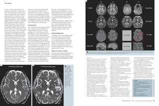 3T 
7T 3T 7T 
22 
Technology Cardiovascular Clinical 
T1 MPR HemoFlash 
T2 TSE Diff (ADC) 
Ax FLAIR T2* GRE 
Not Available 
Sag FLAIR T2* GRE 
Not Available 
22 Summary of results from 3T and 7T neuroimaging protocols. Images at the bottom right indicate that traditional clinical information, preserved by 
the 7T protocol, may be supplemented by sequences which provide unique information at 7T. 
In total, not including time spent on 
localizers, adjustments and slice place-ment, 
the 3T protocol occupies 21 min-utes 
23 seconds, while the 7T protocol 
requires exactly 22 minutes. In these 
essentially equivalent times we have 
produced improved T1- and T2-weighted 
images at higher resolution, comparable 
FLAIR images, and higher-resolution 
HemoFLASH images which suffer from 
greater artifacts near regions of high 
susceptibility gradient than correspond-ing 
3T images. Only with diffusion imag-ing 
do we encounter a real challenge in 
matching the image quality routinely 
obtained at 3T, consistent with the gen-eral 
experience that diffusion imaging 
requires additional optimization at 7T. 
There are a few caveats for the 7T proto-col. 
To match the imaging time we often 
used a reduced phase field-of-view, cre-ating 
a rectangular field-of-view that 
requires more careful placement and 
may not provide sufficient coverage for 
all heads. We have also been unable 
within the scope of this article to show 
the entire set of slices covering the 
whole brain, and there are a few regions 
in the inferior portion of the brain where 
susceptibility and RF inhomogeneity 
artifacts are more pronounced in the 7T 
images than in the 3T images. 
Figure 22 summarizes the results just 
presented, illustrating graphically the 
near-equivalence of routine clinical 
image content at 3T and 7T, combined, 
of course, with the potential for unique 
information only at 7T. Note that similar 
imaging protocol optimizations are likely 
to be possible for routine musculoskele-tal 
imaging, and further work may bring 
other body areas to a similar state. 
Conclusions 
As is evidenced by the images presented 
here, unique information relevant to 
various disease processes is currently 
available at 7T. There has been some 
hesitation in the past about clinical use 
of 7T, given concerns about whether 
traditional clinical information remained 
available despite changes in contrast, 
signal inhomogeneity, SAR limitations, 
etc. Here we demonstrate for a neuroim-aging 
protocol that, with appropriate RF 
coils, pulse sequence modifications, and 
imaging protocol optimizations, 7T scan-ners 
may be used without losing most 
of the key clinical information content 
present in traditional imaging protocols 
at lower field strengths. This means that 
unique information of new clinical value 
may now be accessed without sacrificing 
routine clinical information. After a 
period of exploratory development, a 
portfolio of robust commercially-avail-able 
coils is now available for 7T use. 
Availability of self-shielded 7T scanner 
designs should facilitate incorporation 
into hospital settings, and ongoing work 
on 7T body imaging should continue 
to expand the list of indications for 7T 
imaging. 
In summary, the tool of 7T MRI has been 
carefully tuned over the past several 
years. And increasingly, when we are 
asked the question ‘When will 7 Tesla 
scanners be ready for clinical use?’ we 
may finally respond: ‘Bring on the 
patients!’ 
Acknowlegments 
In addition to all of the colleagues who 
have generously provided images for 
this article, we would like to thank 
Dr. Christian Glaser for helpful conver-sations 
and consultations. We are also 
grateful to the Siemens 7T team and 
particularly to Bernd Stoeckel for his 
ongoing collaboration, motivation, and 
support of our 7T work. 
Note on online content 
Detailed pulse sequence parameters for 
the images and scanning protocols 
described in this article may be found at 
www.siemens.com/magnetom-world 
21 Compari-son 
of appar-ent 
diffusion 
constant (ADC) 
maps at 3T and 
7T. Left: 3T, 
1.2 x 1.2 x 5.0 
mm3, 30 slices 
acquisition 
time 3:56 min. 
Right: 7T, 1.8 x 
1.8 x 3.0 mm3, 
22 slices, dis-tance 
factor 
66%, acquisi-tion 
time 4:06 
min. 
21B 
3T Diffusion (ADC map) 7T Diffusion (ADC map) 
References 
1. Wiggins G, Zhang B, Duan Q, Lattanzi R, Biber S, 
Stoeckel B, McGorty K, Sodickson D. 7 Tesla 
Transmit-Receive Array for Carotid Imaging: 
Simulation and Experiment. Proceedings 17th 
Scientific Meeting, International Society for 
Magnetic Resonance in Medicine, 2009:393. 
2. Finnerty M, Yang X, Zheng T, et al. A 7-Tesla 
High Density Transmit with 28-Channel Receive- 
Only Array Knee Coil. Proceedings 18th Scien-tific 
Meeting, International Society for Magnetic 
Resonance in Medicine. Stockholm, Sweden., 
2010:642. 
3. Wehrli FW, Song HK, Saha PK, Wright AC. Quan-titative 
MRI for the assessment of bone structure 
and function. NMR Biomed 2006;19(7):731-64. 
4. Chang G, Pakin SK, Schweitzer ME, Saha PK, 
Regatte RR. Adaptations in trabecular bone 
microarchitecture in Olympic athletes deter-mined 
by 7T MRI. J Magn Reson Imaging 
2008;27(5):1089-95. 
5. Duan Q, Sodickson DK, Lattanzi R, Zhang B, 
Wiggins G. Optimizing 7T Spine Array Design 
through Offsetting of Transmit and Receive Ele-ments 
and Quadrature Excitation. Proceedings 
18th Scientific Meeting, International Society for 
Magnetic Resonance in Medicine. Stockholm, 
Sweden., 2010:51. 
6. Brown R, McGorty K, Moy L, DeGregorio S, 
Sodickson DK, Wiggins GC. Sub-Millimeter Breast 
Imaging and Relaxivity Characterization at 7T. 
Proceedings 19th Scientific Meeting, Interna-tional 
Society for Magnetic Resonance in Medi-cine. 
Montreal, CA, 2011:3092. 
7. Prudent V, Kumar A, Liu S, Wiggins G, Malaspina 
D, Gonen O. Human hippocampal subfields in 
young adults at 7.0 T: feasibility of imaging. 
Radiology;254(3):900-6. 
8. Mikheev A, Nevsky G, Govindan S, Grossman R, 
Rusinek H. Fully automatic segmentation of the 
brain from T1-weighted MRI using Bridge Burner 
algorithm. J Magn Reson Imaging 
2008;27:1235-1241 (https://files.nyu.edu/hr18/ 
public/projects.html). 
9. Chung S, Kim D, Breton E, Axel L. Rapid B1 
+ 
mapping using a preconditioning RF pulse with 
TurboFLASH readout. Magn Reson Med 
2010;64(2):439-46. 
10. Wiggins C. A Simple Method Of Improving 
MPRAGE Inversion Coverage at 7T. Proceedings 
15th Scientific Meeting, International Society 
for Magnetic Resonance in Medicine. Seattle, 
WA, USA, 2007:3448. 
11. Marques JP, Kober T, Krueger G, W. van der 
Zwang W, Van de Moortele P-F, Gruetter R. 
MP2RAGE contrast optimization at 7T and appli-cations. 
Proceedings 17th Scientific Meeting, 
International Society for Magnetic Resonance 
in Medicine. Honolulu, HI, USA, 2009:2698. 
12. Mukherjee P, Hess CP, Xu D, Han ET, Kelley DA, 
Vigneron DB. Development and initial evaluation 
of 7-T q-ball imaging of the human brain. Magn 
Reson Imaging 2008;26(2):171-80. 
13. Heidemann RM, Porter DA, Anwander A, 
Feiweier T, Heberlein K, Knosche TR, Turner R. 
Diffusion imaging in humans at 7T using 
readout-segmented EPI and GRAPPA. Magn 
Reson Med 2010;64(1):9-14. 
14. von Morze C, Kelley DA, Shepherd TM, Banerjee 
S, Xu D, Hess CP. Reduced field-of-view diffu-sion- 
weighted imaging of the brain at 7 T. 
Magn Reson Imaging 2010;28(10):1541-5. 
15. Sigmund EE, Gutman D. Diffusion-weighted 
Imaging of the Brain at 7 T with Echo-planar and 
Turbo Spin Echo Sequences: Preliminary Results. 
Magnetic Resonance Imaging 2011:in press. 
Contact 
Daniel K. Sodickson, MD, PhD 
Vice-Chair for Research, Department 
of Radiology 
Director, Center for Biomedical Imaging 
New York University Langone Medical 
Center 
660 First Avenue, Fourth Floor 
New York, NY 10016 
USA 
Phone: +1 212-263-4844 
Daniel.Sodickson@med.nyu.edu 
48 MAGNETOM Flash 1/2011 · www.siemens.com/magnetom-world MAGNETOM Flash · 1/2011 · www.siemens.com/magnetom-world 49 
21A 
 