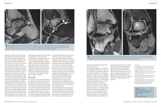 Clinical MSK MSK Clinical 
2A 2B 
2 Coronal images of the ankle. 2A: PD-weighted image which shows the chondral fragment on the talar dome (long arrow). 2B: Fat suppressed 
PD-weighted TSE image which again demonstrates the chondral fragment (long arrow). The increased signal in the body of the talus (arrowhead) 
is consistent with edema in the bone marrow as a result of the repetitive irritation caused by the chondral fragment. 
References 
1 Sijbrandij ES, van Gils APG et al Posttraumatic 
Subchondral Bone Contusions and Fractures 
of the Talotibial Joint: Occurrence of “Kissing” 
Lesions. AJR 2000; 175: 1707-1710. 
2 Magee TH, Ginson GW Usefulness of MR Imaging 
in the detection of talar dome injuries. AJR 
1998; 170: 1227-1230. 
3 Karasick D, Schweitzer ME Pictorial Essay The Os 
trigonum Syndrome: Imaging Features AJR 
1996: 166: 125-129. 
4 Grogan DP, Walling AK et al Anatomy of the os 
trigonum J Pediatr Orthop 1990: 10:618-622 
5 Hedrick MR, McBryde AM Posterior ankle 
impingement Foot Ankle 1994; 15: 2-8. 
Contact 
Charles P. Ho, PhD, MD 
Steadman Philippon Research Institute 
181 W. Meadow Dr. Suite 1000 
Vail, CO 81657 
USA 
Karen.briggs@sprivail.org 
1A 1B 
1 Sagittal images of the ankle. 1A: PD-weighted sagittal image which shows the chondral fragment on the talar dome (long arrow) and the 
diastased os trigonum (short arrow). 1B: Fat suppressed PD-weighted TSE image which again demonstrates the chondral fragment (long arrow) 
and the diastased os trigonum (short arrow). The increased signal in the body of the talus (arrowhead) is consistent with edema in the bone 
marrow as a result of the repetitive irritation caused by instability and ongoing motion of the chondral fragment. 
displayed in Figures 1 and 2. The chon-dral 
fragment is particularly well delin-eated 
by the contrast provided by the 
effusion surrounding the fragment and 
the extensive prominent underlying 
bone edema in the ankle joint and talar 
dome areas. The chondral fragment 
measures approximately 3–4 mm and is 
seen along the mid talar dome. There is 
underlying osseous irregularity, surround-ing 
chondral focal fissuring. Extensive 
prominent increased signal is noted in 
the talar dome and the body which may 
be reactive stress-related edema and/or 
contusion and possible ongoing motion/ 
instability of the fragment. The adjacent 
tibial plafond demonstrates chondral 
thinning and fissuring to bone (Grade IV 
– Outerbridge). Cortical irregularity, scle-rosis 
and remodeling are also noted. The 
presence of increased signal in the body 
of the talus on the fat suppressed Turbo 
Spin Echo images (Figs. 1B and 2B) sig-nifies 
the presence of bone edema which 
is most likely due to the irritation of the 
chondral fragment which is located at a 
has not been established [1] osteochon-dral 
fractures do need to be treated. 
Of the 146 ankles imaged in the series 
analyzed by Sijbrandij et al., it was found 
that bone contusion occurred in the tib-ial 
plafond while osteochondral fractures 
occurred more commonly in the talar 
dome. They conclude that the opposing 
lesions occur due to impaction of the 
talus on the tibia. In this case, however 
the lack of bone contusion in the plafond 
suggests that the plafond injury is chronic 
with resolution of the edema. The 
presence of the talar edema with the 
osteochondral fracture of the talar 
dome suggests that ongoing local 
movement and instability of the osteo-chondral 
fragment could be producing 
a localized bone injury and consequent 
stress related edema. 
Sijbrandij also opined that the explana-tions 
for the higher occurrence of the 
subchondral fractures in the talus rather 
in the plafond is most likely due to the 
fact that the osteochondral lesions are 
more commonly observed on convex 
strategic point trapped at the mid weight 
bearing portion of the talar dome. 
The second is the separation and poste-rior 
tilting of the os trigonum. The os 
trigonum appears diastased by approxi-mately 
3 mm from the lateral tubercle of 
the posterior process with high signal 
widening of the synchondrosis. This is 
most likely related to injury and chronic 
separation at the synchondrosis. The 
findings of the diastased os trigonum 
are visualized on the sagittal images 
seen in Figures 1A and B. 
Discussion 
1. Chondral or osteochondral fracture of 
the talar dome: Ligamentous injuries of 
the ankle are among some of the most 
common sports related injuries involving 
the ankle. When the pain becomes chronic 
or persistent, associated osteochondral 
contusion or fracture should be consid-ered. 
Opposing lesions which involve 
the plafond and the adjacent talar dome 
as in this patient should be sought. While 
the clinical significance of bone contusion 
surfaces with preferentially sparing of 
the concave surfaces. 
2. Os trigonum injury: The os trigonum 
is believed to be analogous to a second-ary 
ossification center being formed from 
a cartilaginous extension of the poste-rior 
portion of the talus [2, 3]. It appears 
between 7–13 years of age, fusing with 
the posterior process of the talus within 
1 year of appearance. In 7–14% patients 
it remains as a separate ossicle – often 
present bilaterally. A cartilaginous 
synchondrosis develops in this region in 
those adults where it remains separate. 
A painful os trigonum may be due either 
from an acute injury or, as likely in this 
case from a chronic repetitive micro-trauma 
and resulting chronic diastasis 
of the synchondrosis [4]. The proximity 
of the flexor hallucis long tendon is a 
feature of which one has to be mindful 
since pressure from the diastased os 
trigonum can lead to tenosynovitis. 
When the involvement of the flexor 
hallucis tendon becomes chronic and 
there is degeneration/tendinosis and 
fibrosis of the tendon between the 
medial and lateral tubercles of the talus, 
there can be reduced flexion of the 
great toe. 
64 MAGNETOM Flash 1/2011 · www.siemens.com/magnetom-world MAGNETOM Flash · 1/2011 · www.siemens.com/magnetom-world 65 
 