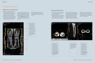 How-Clinical I-do-Cardiovascular 
it How-I-do-it 
Coronal acquisitions 
Setting up the correct fi elds-of-view 
■ Drag the T1 coronal sequences across 
into the queue and open it. This 
sequence displays three separate sub 
protocols. This ensures maximum 
coverage with minimal distortion. 
■ When setting up for any long bones it 
is best to take a systematic approach. 
■ Initially set up your FOV to ensure that 
you are going to cover the entire 
70 MAGNETOM Flash 1/2011 · www.siemens.com/magnetom-world 
Cardiovascular Clinical 
MAGNETOM Flash · 1/2011 · www.siemens.com/magnetom-world 71 
· 1/2011 · www.siemens.com/magnetom-world Setting up the slice positions 
■ Once the FOV has been set you need 
to set the slice group locations for 
each of the subgroups. 
■ The best way to do this is to load your 
individual axial station localizers into 
the two square windows. This helps 
you to visualize your coronal slices. 
region. This involves placing a com-posed 
coronal image of the lower limbs 
into the middle rectangular window. 
■ When setting up your FOV coverage 
ensure coupled graphics is on. This 
can be achieved by right clicking in 
any of the three boxes and selecting 
the option. 
■ With coupled graphics on you can 
then move your FOV and position it 
appropriately for the correct coverage 
(Fig. 6). 
Note the three sepa-rate 
FOV boxes. The 
upper FOV is yellow 
and this indicates that 
it is currently active. 
By utilizing coupled 
graphics you can grab 
and drag all of the 
three and move them 
as one. This makes set-ting 
up your coverage 
very easy. Each FOV is 
also numbered and 
you can select them by 
clicking on the little 
numbers. 
By having an axial 
localizer of the proxi-mal 
tibia in this box 
you can keep an eye 
on your slice coverage 
for the proximal por-tion 
of the lower legs. 
Note that there is rota-tion 
of this sub-proto-col 
about the H–F axis. 
This needs to be done 
with coupled graphics 
on so all sub-protocols 
match otherwise com-position 
will fail. 
A composed sagittal 
gives you an indication 
of both the position of 
your subgroup slice 
positions and also a 
good overview of your 
total FOV. 
By having an axial 
localiser of the distal 
tibia in this box you 
can keep an eye on 
your slice coverage for 
the distal portion of 
the lower legs. Note 
that there is rotation 
of this sub-protocol 
about the H–F axis. 
This needs to be done 
with coupled graphics 
on so all sub-protocols 
match otherwise 
composition will fail. 
■ In the rectangular window place a 
composed sagittal image. This gives 
you an indication of the relationship 
between each subgroup of slices. 
■ Unlike the spinal cord almost all 
patients’ long bones are relatively 
straight. This makes setting the slice 
positions easy. You can leave coupled 
graphics on and move the slices as 
one. Our protocol is set up with plenty 
of slices to allow easy complete cover-age 
in the coronal plane. 
6 7 
 