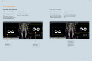 How-Clinical I-do-Cardiovascular 
it How-I-do-it 
Axial acquisitions 
Setting up the correct fi elds-of-view 
■ Drag the T1 Axial sequences across 
into the queue and open it. This 
sequence displays two separate sub-protocols. 
This ensures we have maxi-mum 
coverage with minimal distor-tion. 
■ To allow for the correct FOV you 
should again have a separate proximal 
and distal axial localizer in each of 
72 MAGNETOM Flash 1/2011 · www.siemens.com/magnetom-world 
Cardiovascular Clinical 
switch between the coronal and 
sagittal composed images to ensure 
your slices are perpendicular and 
true axials. 
■ You do this with coupled graphics on 
as the two slice groups are linked and 
this ensures a contiguous run of axial 
slices. 
MAGNETOM Flash · 1/2011 · www.siemens.com/magnetom-world 73 
· 1/2011 · www.siemens.com/magnetom-world Setting up the slice positions 
■ Once the FOV has been set you need 
to set the slice group locations for 
your axials. 
■ In the rectangular window place a 
composed coronal image which 
you can use to position your slices. 
Position your slices to cover the area 
of interest and within this window 
your square windows. This makes it 
easy to ensure your anatomy is in the 
middle of the FOV and that you will 
not cut off anatomical regions as your 
slices progress down the leg. When 
adjusting leave coupled graphics on. 
Distal axial localizer. 
This allows you to 
position the FOV to 
ensure you cover the 
entire distal portion. 
Proximal axial localizer. 
This allows you to 
position your FOV to 
ensure you cover the 
entire proximal portion. 
Switch between the 
coronal composed and 
sagittal composed 
images when setting 
up your slice groups. 
Obviously tailor your 
slice group to cover 
the region of interest. 
8 9 
 