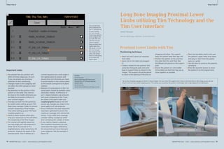 How-Clinical I-do-Cardiovascular 
it How-I-do-it 
10 Long Bone Imaging Proximal Lower 
74 MAGNETOM Flash 1/2011 · www.siemens.com/magnetom-world 
Cardiovascular Clinical 
MAGNETOM Flash · 1/2011 · www.siemens.com/magnetom-world 75 
· 1/2011 · www.siemens.com/magnetom-world Contact 
James Hancock 
Benson Radiology MRI Department 
Ground Floor, 57-59 Anzac Highway 
Ashford 5035 
South Australia 
James.Hancock@bensonradiology.com.au 
Important notes 
■ Any presets that you position will 
affect all three subgroups. As such 
if you use presets you must pay 
attention to their positioning. 
■ Changes made to one subgroup will 
not affect the other groups so never 
assume! 
■ Pay attention to the position of the 
patient on the table, they need to 
be close to the middle otherwise you 
are likely to encounter artifacts on 
your coronal images. 
■ Overlaps are built into the protocols, 
be careful when setting up your FOV. 
Keep these overlaps in place to ensure 
smooth composing of final images. 
Thus when setting up your FOV leave 
coupled graphics on. 
■ Avoid in-plane rotation when plan-ning 
your sequences as this will affect 
the composing of the final images. 
■ For coronal and sagittal sequences 
you may angle your sub-protocols in 
either the A–P (coronal) or R–L 
(sagittal) planes when using these 2D 
protocols. However be aware of the 
previous point. Thus if setting up a 
coronal sequence you could angle in 
the sagittal plane to acquire well 
placed slices but obviously you need 
to avoid rotation in the coronal plane 
as this would correspond to in-plane 
rotation. 
■ Rotation of sub-protocols in the F–H 
(axial) plane should be avoided unless 
absolutely needed. A difference of 
just 1 degree between sub-protocols 
will cause composing to fail. If you 
do rotate in this plane make sure 
coupled graphics is on as this will 
ensure any changes you make in this 
plane apply to all sub-protocols. 
■ At our institution the axial sequences 
have been optimized to ensure the 
maximum coverage with minimal dis-tortion. 
If you need more coverage 
consider adding a subgroup rather 
than increasing the number of slices. 
■ If you need to repeat a subgroup 
due to patient movement you only 
need select the region affected by 
the movement and rerun that parti-cular 
subgroup. See the example in 
figure 10. 
You can see how 
each subgroup for 
the T1 coronals has 
its own number 
3.1, 3.2, 3.3 etc. 
Thus if you need to 
rerun a region sim-ply 
hold shift and 
click the one you 
need to repeat. 
Drag and drop that 
region back into 
the queue. A cross 
will run through 
the compose indi-cator, 
this shows 
that it is only going 
to run that one 
region again. 
Limbs utilizing Tim Technology and the 
Tim User Interface 
James Hancock 
Benson Radiology, Adelaide, South Australia 
Proximal Lower Limbs with Tim 
Positioning technique 
■ Head coil and C-spine coil removed 
from table. 
■ Spine coil on the table and plugged 
in. 
■ Create a bolster for the patients’ feet 
using two triangular pads and sand-bags 
to support them as shown in the 
images. This support should be placed 
as close to the opening of the bore as 
strapping will allow. This support 
helps the patient keep their legs still. 
■ Position the patient on the examina-tion 
table feet first with their feet 
dorsiflexed and placed on the support 
pads. 
■ Ensure the patient is in the middle 
of the table and that their legs are as 
close together as possible. 
■ Place the two Body matrix coils over 
the patient’s upper limbs strap down 
and plug in. Start from the patella 
apex as a guide. 
■ Use the laser to centre to the patients 
symphysis. 
■ Press the isocentre button to move 
the patient in to the magnet bore. 
Set up the triangular sponges as shown in these images. You can move this support even closer to the bore than in this image as you can see 
there is still one more distal strapping point. This allows you to position the patient comfortably with a high degree of immobilisation. 
1B 
 