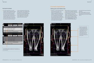 How-Clinical I-do-Cardiovascular 
it How-I-do-it 
Running the localizers 
■ First step to planning is to run the 
localizers. Drag the appropriate HASTE 
localizer into the queue for running. 
You can bring the other sequences 
you will run over at the same time. 
This localizer begins running from the 
symphysis down to mid femur then 
moves the table before running local-izers 
from the mid femur down to the 
knee. We end up with two localizers 
in the running queue and thus a two 
station localizer. Once complete these 
two stations are automatically com-posed 
Inline into one complete image 
for the entire proximal lower limbs 
in both sagittal and coronal planes. 
These images allow us to plan the 
setup for the rest of the scans. 
In this example localizer the patient has very long femurs. As 
such the Technologist has switched from a 3 step protocol to a 
four step protocol. 
78 MAGNETOM Flash 1/2011 · www.siemens.com/magnetom-world 
Cardiovascular Clinical 
MAGNETOM Flash · 1/2011 · www.siemens.com/magnetom-world 79 
· 1/2011 · www.siemens.com/magnetom-world Note the four separate FOV 
boxes. The upper FOV is yel-low 
and this indicates that it 
is currently active. By utilizing 
coupled graphics you can 
grab and drag all of four and 
move them as one. This 
makes setting up your cover-age 
very easy. Each FOV is 
also numbered and you can 
select them by clicking on the 
little numbers. 
4 5 
Coronal acquisitions 
Setting up the correct fi elds-of-view 
■ Drag the T1 coronal sequences across 
into the queue and open it. The 
default is a 3 step protocol. This 
sequence displays three separate sub-protocols. 
This ensures we have maxi-mum 
coverage with minimal distor-tion. 
If upon opening this sequence it 
becomes obvious that you will not have 
enough coverage then there is also 
a four station sub protocol available. 
Some people have very long legs! 
■ When setting up for any long bones it 
is best to take a systematic approach. 
■ Initially set up your FOV to ensure that 
you are going to cover the entire 
region. This involves placing a com-posed 
coronal image of the lower limbs 
into the middle rectangular window. 
■ When setting up your FOV coverage 
ensure coupled graphics is on. This 
can be achieved by right clicking in 
any of the three boxes and selecting 
the option. 
■ With coupled graphics on you can 
then move your FOV and position it 
appropriately for the correct coverage 
(Fig. 6). 
6 
 