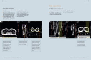 How-Clinical I-do-Cardiovascular 
it How-I-do-it 
Setting up the slice positions 
By having an axial localizer of 
the proximal femur in this box 
you can keep an eye on your 
slice coverage for the proxi-mal 
portion of the lower legs. 
This sub-protocol is not 
rotated about the H–F axis 
which is ideal. However if this 
needs to be done do so with 
coupled graphics on so all 
sub-protocols match. Other-wise 
composition will fail (see 
80 MAGNETOM Flash 1/2011 · www.siemens.com/magnetom-world 
Cardiovascular Clinical 
MAGNETOM Flash · 1/2011 · www.siemens.com/magnetom-world 81 
· 1/2011 · www.siemens.com/magnetom-world important notes). 
A composed sagittal gives you 
an indication of both the posi-tion 
of your subgroup slice 
positions and also a good 
overview of your total FOV. 
By having an axial localiser of 
the distal femur in this box 
you can keep an eye on your 
slice coverage for the distal 
portion of the lower legs. This 
sub-protocol is not rotated 
about the H–F axis which is 
ideal. However if this needs to 
be done do so with coupled 
graphics on so all sub-proto-cols 
match otherwise compo-sition 
will fail (see important 
notes). 
The proximal axial localizer 
allows you to position your 
FOV to ensure you cover all of 
the proximal portion assum-ing 
of course that the region 
of interest lies in this region. 
■ Once the FOV has been set you need 
to set the slice group locations for 
each of the subgroups. 
■ The best way to do this is to load your 
individual axial station localizers into 
the two square windows. This helps 
you to visualise your coronal slices. 
■ In the rectangular window place a 
composed sagittal image. This gives 
you an indication of the relationship 
between each subgroup of slices. 
■ Unlike the spinal cord almost all 
patients’ long bones are relatively 
straight. This makes setting the slice 
positions easy. You can leave coupled 
graphics on and move the slices as 
one. The protocol is set up with plenty 
of slices to allow easy complete cover-age 
in the coronal plane. 
Axial acquisitions 
Setting up the correct fi elds-of-view 
■ Drag the T1 axial sequence across into 
the queue and open it. This is a single 
slice group. 
■ To allow for the correct FOV you can 
place a coronal, sagittal and axial set 
of images in each window. This makes 
it easy to ensure your anatomy is in 
the middle of the FOV and that you 
will not cut off anatomical regions as 
your slices progress down the leg. 
7 8 
 