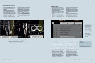 How-Clinical I-do-Cardiovascular 
it How-I-do-it 
Setting up the slice positions 
■ Once the FOV has been set you need 
to set the slice group locations for 
your axials. 
■ Making use of the three windows 
place coronal sagittal and axial slice 
groups into each. You can then easily 
identify the relevant region of interest 
and ensure your slice groups are run-ning 
through that region. If there is 
concern over coverage consider turn-ing 
the single slice group into a multi- 
step protocol by adding a sub-protocol 
from the Tim planning suite toolbar. 
■ Depending on your choice of axials if 
you need to cover a large region then 
you will be using a multi group 
sequence. In this case when setting 
up do so with coupled graphics on as 
the two slice groups are linked and 
this ensures a contiguous run of axial 
slices. 
Coronal and sagittal slices make it very easy to identify the 
region your slices should cover in the axial plane. 
82 MAGNETOM Flash 1/2011 · www.siemens.com/magnetom-world 
Cardiovascular Clinical 
You can see how each 
subgroup for the T1 coro-nals 
has its own number 
3.1, 3.2, 3.3 etc. Thus if 
you need to rerun a 
region simply hold shift 
and click the one you 
need to repeat. Drag and 
drop that region back 
into the queue. A cross 
will run through the 
compose indicator, this 
shows that it is only 
going to run that one 
region again. 
MAGNETOM Flash · 1/2011 · www.siemens.com/magnetom-world 83 
· 1/2011 · www.siemens.com/magnetom-world Important notes 
■ Any presets that you position will 
affect all three subgroups. As such if 
you use presets you must pay atten-tion 
to their positioning. 
■ Changes made to one subgroup will 
not affect the other groups so never 
assume! 
■ Pay attention to the position of the 
patient on the table, they need to 
be close to the middle otherwise you 
coronal sequence you could angle in 
the sagittal plane to acquire well 
placed slices but obviously you need 
to avoid rotation in the coronal plane 
as this would correspond to in-plane 
rotation. 
■ Rotation of sub-protocols in the F–H 
(axial) plane should be avoided unless 
absolutely needed. A difference of 
just 1 degree between sub-protocols 
Contact 
James Hancock 
Benson Radiology MRI Department 
Ground Floor, 57–59 Anzac Highway 
Ashford 5035 
South Australia 
James.Hancock@bensonradiology.com.au 
10 
are likely to encounter artefacts on 
your coronal images. 
■ Overlaps are built into the protocols, 
be careful when setting up your FOV. 
Keep these overlaps in place to ensure 
smooth composing of final images. 
Thus when setting up your FOV leave 
coupled graphics on. 
■ Avoid in-plane rotation when plan-ning 
your sequences as this will affect 
the composing of the final images. 
■ For coronal and sagittal sequences 
you may angle your sub-protocols in 
either the A–P (coronal) or R–L (sagit-tal) 
planes when using these 2D 
protocols. However be aware of the 
previous point. Thus if setting up a 
will cause composing to fail. If you do 
rotate in this plane make sure coupled 
graphics is on as this will ensure any 
changes you make in this plane apply 
to all sub-protocols. 
■ The axial sequences have been opti-mised 
to ensure the maximum cover-age 
with minimal distortion. If you 
need more coverage consider adding 
a subgroup rather than increasing 
the number of slices. 
■ If you need to repeat a subgroup 
due to patient movement then you 
only need select the region affected 
by the movement and rerun that 
particular subgroup. See the example 
in figure 10. 
9 
 