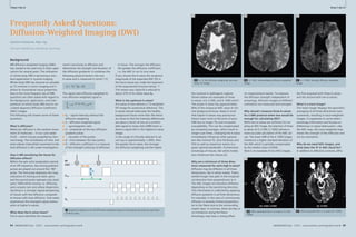 Clinical Cardiovascular 
Frequently Asked Questions: 
Diffusion-Weighted Imaging (DWI) 
Joachim Graessner, Dipl. Ing. 
Siemens Healthcare, Hamburg, Germany 
RF 
ADC 
Gdiff 
Gr 
Gp 
84 MAGNETOM Flash 1/2011 · www.siemens.com/magnetom-world 
Cardiovascular Clinical 
b0, b500, b1000 b0, b1000 
MAGNETOM Flash · 1/2011 · www.siemens.com/magnetom-world 85 
the contrast in pathogenic regions. 
Shown below are examples of three 
b-values: b 0, b 500, and b 1000 s/mm2. 
The proper b-value has approximately 
80% of the reciprocal ADC value of nor-mal 
background tissue. Keep in mind 
that higher b-values may pronounce 
lesions even more at the price of poor 
SNR due to longer TEs and increased 
susceptibility. This can be compensated 
by increasing averages, which result in 
longer scan times. Changing the b-value 
immediately influences other parame-ters 
like minimal TE, slice thickness and 
FOV as well as maximum matrix at a 
given optimal bandwidth. Furthermore 
anisotropy of tissues, like white matter, 
also influences the choice [2]. 
Why are a minimum of three direc-tions 
measured for each high b-value? 
Diffusion may be different in all three 
dimensions, like in white matter. Fibers 
exhibit longer free path in the longitudi-nal 
direction than perpendicular to it. 
The ADC images are therefore different 
depending on the sensitizing direction. 
This information is collected by applying 
diffusion gradients in all three dimensions. 
For example, in the case of commissures, 
diffusion is severely limited perpendicu-lar 
to the fibers due to the surrounding 
myelin layer. In contrast, there are few or 
no limitations along the fibers. 
Anisotropy may have a strong effect 
on measurement results. To measure 
the diffusion strength independent of 
anisotropy, diffusion images of different 
orientation are measured and averaged. 
Why should I measure three b-values 
for a DWI protocol when two would be 
enough for calculating ADC? 
While two b-values are sufficient for cre-ating 
an ADC image, the selection of three 
b-values (b 0, b 500, b 1000) delivers a 
more accurate calculation of the ADC val-ues. 
The lower SNR of the b 1000 images 
introduces a higher standard deviation of 
the ADC which is partially compensated 
by the median value of b500. 
Here is an example of two ADC images, 
the first acquired with three b-values 
and the second with two b-values. 
What is a trace image? 
The ‘trace image’ displays the geometric 
averaging of all three directional mea-surements, 
resulting in trace-weighted 
images. It suppresses to some extent 
anisotropy information and focuses on 
differences in signal attenuation. Like 
the ADC map, the trace-weighted map 
shows the strength of the diffusion and 
not its orientation. 
Why do we need ADC images, and 
what does the ‘A’ in ADC stand for? 
In addition to diffusion contrast, diffu- 
Background 
MR diffusion-weighted imaging (DWI) 
has ceased to be used only in brain appli-cations 
for several years. The utilization 
of whole body DWI is becoming a stan-dard 
application in routine imaging. 
Whole body DWI has become as valuable 
as T2 contrast in tumor imaging and it 
allows to characterize tissue properties. 
Due to the more frequent use of DWI, 
questions are often asked with regard to 
the background, application, and inter-pretation 
of whole body DWI and its cal-culated 
Apparent Diffusion Coefficient 
(ADC) images. 
The following will answer some of these 
questions. 
What is diffusion? 
Molecular diffusion is the random move-ment 
of molecules – in our case water 
(H2O) – within tissues propelled by ther-mal 
energy. The contribution of intra- and 
extra-cellular (interstitial) movement to the 
total diffusion is still under investigation. 
How is MR sensitizing the tissue for 
diffusion effects? 
Within the spin echo preparation period 
of an EPI sequence, two strong gradient 
pulses are played out around the 180° 
pulse. The first pulse dephases the mag-netization 
of moving and static spins 
and the second pulse rephases only static 
spins 100% while moving i.e. diffusing 
spins acquire non-zero phase dispersion, 
resulting in a stronger signal dampening 
of tissues with fast diffusion compared 
to tissues with slow diffusion. Free water 
experiences the strongest signal attenu-ation 
at higher b-values. 
What does the b-value mean? 
The b-value identifies the measure- 
· 1/2011 · www.siemens.com/magnetom-world How-I-do-it 
2A 2B 2C 
2A b = 0. No diffusion weighting, low-reso-lution 
T2 image. 
2B b = 500. Intermediately diffusion-weighted 
image. 
2C b = 1000. Strongly diffusion-weighted 
image. 
ment's sensitivity to diffusion and 
determines the strength and duration of 
the diffusion gradients. It combines the 
following physical factors into one 
b-value and is measured in s/mm² [1]. 
b = 2G2 2(Δ– /3) 
The signal ratio diffusion-weighted to 
non diffusion-weighted signal is: 
■ S0 – signal intensity without the 
diffusion weighting 
■ S – diffusion-weighted signal 
■ – gyromagnetic ratio 
■ G – amplitude of the two diffusion 
gradient pulses 
■ – duration of the pulses 
■ Δ – time between the two pulses 
■ D – diffusion coefficient is a measure 
of the strength (velocity) of diffusion 
in tissue. The stronger the diffusion, 
the greater the diffusion coefficient, 
i.e. the ADC in our in vivo case. 
If you choose the b-value the reciprocal 
magnitude of the expected ADC (D) in 
the focus tissue you make the exponent 
of the exponential function being ‘-1’. 
This means your signal S is reduced to 
about 37% of its initial value S0. 
What is the optimum b-value? 
A b-value of zero delivers a T2-weighted 
EPI image for anatomical reference. The 
b-values should attenuate the healthy 
background tissue more than the lesion 
at a level so that the intensity differences 
are about a factor of two at a comfort-able 
signal-to-noise ratio (SNR) level i.e. 
there is signal left in the highest b-value 
image. 
In the range of clinically-relevant b-val-ues 
(up to approximately 1,000), then 
the greater the b-value, the stronger 
the diffusion weighting and the higher 
S 
S0 
= e- 2G2 2(Δ- /3)D = e-bD 
3A 3B 
3A ADC calculated from 3 b-values ( 0, 500, 
1000). 
3B ADC calculated from 2 b-values (0, 1000). 
G 
Δ 
1 Sequence diagram of an EPI diffusion-weighted sequence illustrating the physical quantities 
of the b-value. 
1 
How-I-do-it 
 