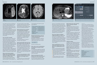 Clinical Cardiovascular 
4A 4B 
4A b1000 image; infarct is brighter than nor-mal 
tissue. 
86 MAGNETOM Flash 1/2011 · www.siemens.com/magnetom-world 
Cardiovascular Clinical 
References 
1 Le Bihan D, Breton E, Lallemand D, Grenier P, 
Cabanis E, Laval-Jeantet M (1986). MR imaging 
of intravoxel incoherent motions; application to 
diffusion and Perfusion in neurologic disorders. 
Radiology. 161: 401-407. 
2 Kingsley PB, Monahan WG (2004) Selection 
of the Optimum b Factor for Diffusion-Weighted 
Magnetic Resonance Imaging Assessment of 
Ischemic Stroke. MRM 51: 996-1001. 
3 Provenzale JM, Engelter ST, Petrella JR, Smith JS, 
MacFall JA (1998). Use of MR Exponential 
Diffusion-Weighted Images to eradicate T2 
“Shine-Through” Effect. AJR. 172:537-539. 
4 Padhani AR, Liu G, Mu-Koh D, Chenevert TL, 
Thoeny HC, Takahara T, Dzik-Jurasz A, Ross BD, 
Van Cauteren M, Collins D, Hammoud DA, 
Rustin GJS, Taouli B, Choyke PL (2009). Diffu-sion- 
Weighted Magnetic Resonance Imaging 
as a Cancer Biomarker: Consensus and 
Recommendations. NEOPLASIA.11 (2): 102-125. 
5 de Bazelaire CMJ, Duhamel GD, Rofsky NM, 
Alsop DC (2004).MR Imaging Relaxation Times 
of Abdominal and Pelvic Tissues in Vivo at 3.0 T. 
Radiology 230: 652-659. 
6 Hagmann P, Jonasson L, Maeder P, Thiran JP, 
Van Wedeen J, Meuli R (2006). Understanding 
Diffusion MR Imaging Techniques: From Scalar 
Diffusion-weighted Imaging to Diffusion Tensor 
Imaging and Beyond. Radiographics 26: 205-223. 
MAGNETOM Flash · 1/2011 · www.siemens.com/magnetom-world 87 
· 1/2011 · www.siemens.com/magnetom-world How-I-do-it 
sion images also have an overlaying T2 
contrast. In regions with long T2, this 
can simulate reduced diffusion (‘T2 
Shine-Through’). These portions of the 
signal can be eliminated by calculating 
a pure diffusion coefficient. 
The ‘A’ stands for apparent because we do 
not measure the pure diffusion coefficient 
(D or DC). In living tissue the diffusion 
process is superimposed by capillary 
pseudo diffusion and gross motion to 
which the MR measurement is also 
very sensitive. 
How is the ADC calculated? 
Having measured a set of at least 2 dif-ferent 
b-value images (e.g., b 0 and b 
1000 s/mm²) the system calculates pixel 
by pixel the ADC by linear regression. 
The ADC pixel values together form the 
ADC map. On a half logarithmic scale, the 
signal decay delivers a straight tilted line 
whose slope provides the ADC. The 
faster the signal decay the steeper the 
slope and the higher the ADC. 
The Diffusion image (b 1000) below dis-plays 
reduced diffusion as hyperintense 
(brighter pixels); in contrast the ADC map 
displays it as hypointense (darker pixels). 
Why are some lesions typically 
brighter than the background brain 
tissue on the higher b-value image 
and darker on the ADC map? 
Due to the nature of certain lesions 
and their missing perfusion, the cells 
swell and hinder a normal diffusion; i.e., 
4B ADC Image; infarct appears darker than 
normal tissue. 
spicuous. The calculation of the tissue 
ADC can be more accurate when start-ing 
with even higher b-values like 100 or 
200 to omit the contribution of flow and 
micro vascular effects. Low b-values 
more often serve as anatomical reference. 
In software level syngo MR D11A and 
above you can delimit the b-values for 
ADC calculation on the body diffusion 
application card of the protocol. 
Why do liver diffusion-weighted 
images look darker on 3T than 1.5T? 
The T2 and T2* relaxations times for 
liver tissue, and other tissues as well, are 
considerably shorter as the field strength 
increases The overall signal is therefore 
diminished at 3T, even at lower b-values, 
due to the relatively long echo times (TE) 
used in DWI [5]. 
Which new DWI features are intro-duced 
with software version syngo 
MR D11A for MAGNETOM Aera and 
Skyra? 
There is a new ‘body diffusion’ applica-tion 
card with many new applications: 
■ diffusion scheme monopolar/bipolar 
■ start ADC calculation for b > = … 
■ exponential ADC; no T2 shine-through 
■ invert gray scale (“PET-like” image) 
■ calculated image of artificial b-values 
plus 
■ choice of dynamic field correction 
■ improved fat saturation schemes 
What should I know when scanning 
liquids in phantoms with DWI 
sequences? 
Firstly, the liquids should not move in 
the phantom bottle. Flowing liquid in 
the phantom would cause artificially 
strong diffusion and results in low inten-sity 
DWI images with inaccurately long 
ADC values. 
Secondly, the diffusion coefficient is also 
strongly temperature dependent. Pure 
water has a diffusion coefficient of about 
3 *10-3 mm²/s (exactly: 2.96) at body 
temperature of 37 °C (98.6 °F). Water of 
0 °C (32 °F) has a diffusion coefficient 
of 1.12 * 10-3 mm²/s. This could serve as 
a standard for different machines. 
Additional reading 
In addition to the comprehensive Siemens 
applications guide, “Diffusion/Perfusion 
Imaging”, there is literature [6] available 
which covers neuro and body diffusion. 
(Listed according to year of publication): 
Derek K. Jones: Diffusion MRI: Theory, 
Methods, and Applications; Oxford Uni-versity 
Press 
Bachir Taouli: Extra-Cranial Applications 
of Diffusion-Weighted MRI; Cambridge 
University Press 
Dow-Mu Koh: Diffusion-Weighted MR 
Imaging: Applications in the Body; Springer 
Heidi Johansen-Berg: Diffusion MRI: 
From Quantitative Measurement to 
In-Vivo Neuroanatomy; Academic Press 
Contact 
Joachim Graessner, Dipl. Ing. 
Siemens Healthcare 
GER H IM BM MR 
Lindenplatz 2 
20099 Hamburg 
Germany 
joachim.graessner@siemens.com 
5 
5 b50 image of normal liver at 3T. 
6 
6 syngo body-diffusion card in software version syngo MR D11A. 
the mean free path is shorter. Water 
molecules cannot move as far in the dam-aged 
tissue as in normal tissue. As a 
result, the ADC is lower and appears darker 
than the surrounding normal tissue. 
Which benefit does the calculation 
of an exponential map deliver? 
The exponential map or image is calcu-lated 
by dividing the maximal b-value 
diffusion-weighted image by the b0 
image. Mathematically the exponential 
map displays the negative exponential 
of the ADC; it is a synthetic diffusion-weighted 
image without T2 ‘shine-through’ 
effect. 
The contrast behaviour is similar to 
the high b-value image [3]. 
How do I get the ADC value out of my 
ADC image and what is the right unit? 
Place a region of interest (ROI) on the 
ADC map and record the mean value in 
that ROI. A value of 850 intensity points 
is to be interpreted as 0.85 10-3 mm²/s. 
This is valid for software versions since 
syngo MR B13. Systems with A-level 
software (e.g., syngo MR A30) and syngo 
MR B11, a mean value of 85 delivers the 
result above. 
There are many publications on DWI 
and ADC. But why are there so many 
different unit and digits used for 
ADCs? 
Currently, there is no consensus about 
applied units in DWI. You will find all 
4C 
4C Exponential-Map 
of the following units which are equal 
(syngo MR B13). 
A mean intensity of 1000 is equal to: 
1.0*μm²/ms or intensity times 10-3 
1.0*10-3 mm²/s or intensity times 10-6 
1.0*10-5 cm²/s or intensity times 10-8 
1.0*10-9 m²/s or intensity times 10-12 
Also found: 
1000*10-6 mm²/s 
1000*μm²/s 
Why does the ADC have a unit of an 
area/time although diffusion occurs 
in all three dimensions? 
By definition, the diffusion coefficient 
is defined as the product of 1/3 times 
medial velocity times mean free path: 
D = 1/3*v’* l 
The unit is an area per time. 
Why is there a lack of standardization 
for the choice of b-values in whole 
body DWI? 
As a relatively new application body DWI 
is on its way to become a technique with 
recommended b-values and measurement 
conditions. See cited reference [4] for 
further information. 
Why do most body and liver DWI 
protocols start with b-value 50 s/mm²? 
The selection of a low b-value larger 
than zero provides suppression of large 
vessels which makes lesions more con- 
How-I-do-it 
 
