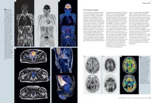 Product Clinical Cardiovascular 
News Product News 
98 MAGNETOM Flash 1/2011 · www.siemens.com/magnetom-world 
MAGNETOM Flash · 1/2011 · www.siemens.com/magnetom-world 99 
11 Patient with 
lymph node filiae 
following a history 
of a penis carci-noma. 
Images (A–C) 
show whole-body 
T1-weighted MR 
image (A), attenua-tion 
corrected PET 
(B), and MR/PET 
hybrid images (C) in 
a coronal orienta-tion, 
that were all 
simultaneously 
acquired in a multi-station/ 
multi-bed 
acquisition mode. 
MRI in this whole-body 
study (A) dis-plays 
anatomical 
structures with 
exquisite detail and 
excellent soft-tissue 
contrast. PET (B) 
and the combined 
MR/PET hybrid 
image (C) in this 
coronal overview 
show enhanced 
tracer activity in one 
lymph node on the 
right side of the 
patient. The axial 
and sagittal refor-mates 
of the MR/PET 
hybrid data (D, wE) 
reveal two addi-tional 
lymph nodes 
with focal tracer 
activity on the right 
side. 
First clinical examples 
An early study was initiated in 2010 at 
the Institute of Medical Physics (IMP), 
University of Erlangen, in cooperation 
with Siemens AG Healthcare Sector, 
Erlangen. This study aimed at system 
integration testing and at showing sys-tem 
performance and full operationality 
by scanning first patients. For acquiring 
these images, the study was setup as 
follows: Patients referred to PET/CT scan-ning 
were recruited from the Nuclear 
Medicine Department of the nearby Uni-versity 
Hospital Erlangen. Patients had 
been injected the radioactive tracer 
18F-Fluordesoxyglucose (FDG) and had 
already undergone their PET/CT exami-nation 
immediately before participating 
in the MR/PET hybrid imaging examina-tion. 
This study design thus also had the 
benefit that the preceding PET/CT exami-nation 
could serve as a ‘gold standard’ 
comparison for subsequent MR/PET 
imaging. No additional FDG injection or 
increased radiation dose was necessary. 
Due to the scanning PET/CT first, how-ever, 
patients involved in this study had 
their MR/PET examination on average 
about 120 min after the injection of 
FDG. This is about 60 min later than the 
PET scan would usually have been per-formed 
after 18F-FDG-injection. With the 
given half life time of 108 min for 18F-FDG, 
this has the effect that activity and 
thus count rate have already decreased 
since the PET/CT examination and addi-tionally, 
FDG has been metabolized 
during a longer time window than usual. 
In our study, the effect of decreased 
activity has been compensated for by 
longer PET measurement times per 
bed position (i.e. 6 minutes instead of 
2–3 minutes per bed position). 
Figure 11 shows a whole-body MR/PET 
study of a patient with a history of a 
penis carcinoma with R0 resection of the 
tumor and now suspicion of tumor recur-rence 
(lymph node metastases). The MR/ 
PET study in this case revealed multiple 
lymph node filiae inguinal and iliacal, 
which can be displayed in fine detail in 
PET and in MRI. These findings correlate 
well with the findings of the preceding 
PET/CT examination (not shown). 
Figure 12 shows a brain MR/PET study of 
a lung cancer patient for therapy effec-tivness 
control with a history of 2 
resected brain metastases. No increased 
activity or any other signs of recurrence 
or malignancy could be observed – 
neither in the PET nor in the MR images. 
This also correlates with the findings 
of the associated PET/CT examination 
(not shown). 
12 Case of a patient 
with successfully 
treated lung carcinoma 
and with two resected 
brain metastasis (both 
right side). The axial 
slices show MR (A) and 
PET (B) images simul-taneously 
acquired at 
each position of the 
resected brain metas-tasis. 
The T2-weighted 
and inverted MR data 
set (A) shows the ana-tomical 
structures in 
fine detail and with 
excellent soft tissue 
contrast. The PET 
images (B) and the 
resulting MR/PET data 
set (C) does not show 
any signs of recurrence. 
12A 12B 12C 
11A 11B 11C 
11D 11E 
 