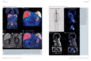 Clinical mMR mMR Clinical 
Case 2 Patient with a Neuroendocrine tumor. 
2A 2B 
Dotatoc-PET 
R 
L 
MRI Fusion Dotatoc-PET & MRI 
R 
2C 2D 
L 
L L 
MR/PET München (TUM/LMU) funded by the DFG. 
R R 
2 A: Overview using the water image of the MR AC Dixon sequence. Note the area of intense focal tracer uptake in the right upper quadrant 
of the abdomen, projecting on the region of the terminal ilium. There is a small bladder diverticulum of the left lateral bladder wall with tracer 
retention as accidental finding. B: PET-findings with 68Ga-DOTATOC, a tracer binding to somatostatine-receptors which are expressed frequently 
on neuroendocrine tumors. An intense focal tracer-uptake can be found in the abdomen. C: MR-image, fat-suppressed coronal T1w breathold 
VIBE sequence. D: Fusion of PET and MR-findings. An excellent identification and anatomical allocation of the tumor is possible by combination 
of PET and MRI findings. No additional suspect lesions are apparent. 
Case 3 Patient with bone metastases of a prostate cancer. 
3 A: Overview of the 
18F-Fluoride PET scan. B: 
PET-findings. C: MR-image, 
sagittal fat-weighted MR 
AC Dixon sequence. 
D: Fusion of PET and MR-findings. 
Upper row: sagit-tal 
slices, Lower row: axial 
slices. The Fluoride-PET 
scan shows a number of 
suspect lesions in the skel-eton, 
likely corresponding 
to bone metastases of the 
prostate-cancer. On the 
MR- and the fusion-images 
it is apparent that in the 
region of the increased 
PET-tracer uptake, dis-placement 
of the bone 
marrow has occurred, 
underlining the suspicion 
of bone metastases. 
3A 3B 
Fluoride-PET Bone Metabolism Fluoride-PET Bone Metabolism 
A 
R 
L 
MRI Dixon sequence Fusion Fluorid-PET & MR 
R 
3C 3D 
P 
L 
P 
L L 
MR/PET München (TUM/LMU) funded by the DFG. 
A 
A 
P 
R R 
106 MAGNETOM Flash 1/2011 · www.siemens.com/magnetom-world MAGNETOM Flash · 1/2011 · www.siemens.com/magnetom-world 107 
 