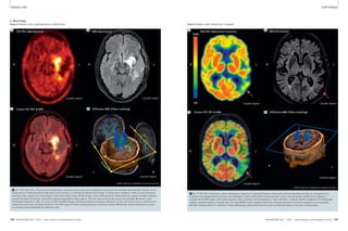 Clinical mMR mMR Clinical 
2. Neurology 
Case 4 Patient with a glioblastoma multiforme. 
4A 4B 
4C 
FET-PET (Metabolism) MRI (Structure) 
R L R L R L R L 
Caudal aspect Caudal aspect 
Fusion FET-PET & MRI 4D 
Diffusion-MRI (Fibre tracking) 
R 
Cranial aspect 
R L 
Caudal aspect 
L 
MR/PET München (TUM/LMU) funded by the DFG. 
4 A: 18F-FET PET scan. The tracer FET represents a measure of the amino acid metabolism and allows the sensitive identification of brain tumor 
tissue which is characterized by high amino acid turnover, in contrast to healthy brain tissue. A strong tracer uptake is visible around a previous 
resection area, suspect for remaining/recurrent brain tumor tissue. B: MR-image, axial FLAIR-sequence, demonstrating a region of hyper intensity 
around the area of resection, potentially representing edema and/or gliosis, but also vital tumor tissue cannot be excluded. Moreover, a left 
frontopolar hygroma is seen. C: Fusion of PET and MR-findings, allowing excellent anatomical allocation of the vital tumor tissue in reference to 
anatomical structures and abnormalities in the MR-image. D: Fibre-tracking based on a diffusion-tensor MR dataset, demonstrating the course 
of neuronal axons alongside the resection area. 
Case 5 Patient with Alzheimer’s disease. 
5A 5B 
5C 
FDG-PET (Neuronal function) MRI (Structure) 
Caudal aspect Caudal aspect 
100% 
0% 
Fusion FET-PET & MRI 5D 
Diffusion-MRI (Fibre tracking) 
R L 
Cranial aspect 
R L 
Caudal aspect 
MR/PET München (TUM/LMU) funded by the DFG. 
5 A: 18F-FDG-PET of the brain, which represents a measure of neuronal function. Areas with reduced neuronal function in consequence of 
ongoing neurodegenerative processes are displayed in green-yellow (left temporoparietal cortex, see red arrow), healthy brain regions in 
orange-red. B: MR-image, axial FLAIR-sequence. Brain anatomy can be displayed in high resolution, cerebral atrophy is apparent in widespread 
regions, predominantly on the left side. C: In the MR/PET fusion regional allocation of hypometabolism and brain substance loss is possible. 
D: Fibre-tracking based on a diffusion-tensor MR dataset, demonstrating the course of neuronal axons in the brain of the patient. 
108 MAGNETOM Flash 1/2011 · www.siemens.com/magnetom-world MAGNETOM Flash · 1/2011 · www.siemens.com/magnetom-world 109 
 