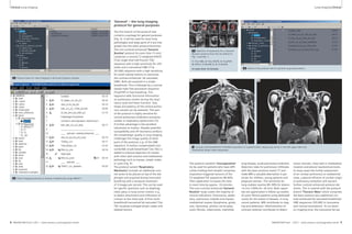 Clinical Lung Imaging Lung Imaging Clinical 
3A 3B 
1 2 3 4 5 
3A Selection of sequences for a ‘General- 
Routine’ protocol from the list offered in 
Fig. 1 and Tab. 1. 
1: T1w VIBE, 2: T2w HASTE, 3: TrueFISP, 
4: STIR or T2 BLADE fs, 5: T2 BLADE 
In-room time 15 minutes 3B Detail of the protocol tree for general lung examinations. 
4A 4B 
4 Coronal multi-breathhold T2 BLADE acquisition in a patient with a large lung cancer in the left upper lobe and 
mediastinal lymph node metastases. 
‘General’ – the lung imaging 
protocol for general purposes 
The first branch of the protocol tree 
contains a package for general purposes 
(Fig. 3). It will be used for most lung 
pathologies and large parts of it are inte-grated 
into the other protocol branches. 
The non-contrast-enhanced ’General 
Routine’ protocol (in-room time 15 min) 
comprises a coronal T2-weighted HASTE 
(T2w single-shot half-Fourier TSE) 
sequence with a high sensitivity for infil-trates 
and a transversal VIBE (T1w 
3D-GRE) sequence with a high sensitivity 
for small nodular lesions (in particular 
the contrast-enhanced, fat saturated 
VIBE). Both are acquired in a single 
breathhold. This is followed by a coronal 
steady-state free precession sequence 
(TrueFISP) in free breathing. This 
sequence adds functional information 
on pulmonary motion during the respi-ratory 
cycle and heart function. Size, 
shape and patency of the central pulmo-nary 
vessels can be assessed. This part 
of the protocol is highly sensitive for 
central pulmonary embolism and gross 
cardiac or respiratory dysfunction [3]. 
A further advantage is the excellent 
robustness to motion. Despite potential 
susceptibility and off resonance artifacts 
the morphologic quality in lung imaging 
challenges the image quality of other 
parts of the protocol, e.g. of the VIBE 
sequence. A motion-compensated coro-nal 
BLADE (multi-breathhold T2w TSE) is 
added to improve depiction of masses 
with chest wall invasion and mediastinal 
pathology such as masses, lymph nodes 
or cysts (Fig. 4). 
The protocol variant ‘Respiratory 
Mechanics’ includes an additional coro-nal 
series to be placed on top of the dia-phragm 
and acquired during instructed 
breathing with a temporal resolution 
of 3 images per second. This can be used 
for specific questions such as diaphrag-matic 
palsy or lung tumor motion, e.g. 
to detect attachment and infiltration of 
a lesion to the chest wall. A final multi-breathhold 
transversal fat-saturated T2w 
TSE visualizes enlarged lymph nodes and 
skeletal lesions. 
2A 
2A Protocol trees for chest imaging in the Exam Explorer window. 
2B 
2B Chest imaging protocols as already installed with syngo MR B17. 
The protocol variation ‘Uncooperative’ 
(to be used for patients who have diffi-culties 
holding their breath) comprises 
respiration-triggered versions of the 
T2-weighted TSE sequences (BLADE). 
Their application increases the total 
in-room time by approx. 10 minutes. 
This non-contrast enhanced ‘General- 
Routine’ study covers the majority of 
clinical indications: Pneumonia, atelec-tasis, 
pulmonary nodules and masses, 
mediastinal masses (lymphoma, goiter, 
cyst, thymoma), phrenic nerve palsy, 
cystic fibrosis, tuberculosis, interstitial 
lung disease, acute pulmonary embolism. 
Detection rates for pulmonary infiltrates 
with the basic protocol match CT and 
make MRI a valuable alternative in par-ticular 
for children, young patients and 
pregnant women. The sensitivity for 
lung nodules reaches 80–90% for lesions 
>4 mm (100% for >8 mm). Both capaci-ties 
are appreciated in follow-up studies 
of cystic fibrosis patients using dedicated 
scores for the extent of disease. In lung 
cancer patients, MRI contributes to stag-ing 
and atelectasis. Administration of 
contrast material contributes to detect 
tumor necrosis, chest wall or mediastinal 
invasion and pleural reaction/carcinosis. 
In many cases the further assessment 
of an unclear pulmonary or mediastinal 
mass, a pleural effusion of unclear origin 
or pulmonary embolism will warrant 
further contrast enhanced protocol ele-ments. 
This is covered with the protocol 
branch ‘Thoracic Mass’ which comprises 
the basic protocol plus additional con-trast- 
enhanced fat-saturated breathhold- 
VIBE sequences (3D GRE) in transverse 
and coronal orientations. To cut down 
on imaging time, the transverse fat-sat- 
8 MAGNETOM Flash 1/2011 · www.siemens.com/magnetom-world MAGNETOM Flash · 1/2011 · www.siemens.com/magnetom-world 9 
 