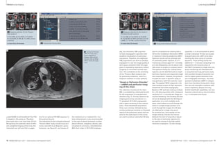 Clinical Lung Imaging Lung Imaging Clinical 
5A 7A 
1 2 3 4 
5 6 
5B 7B 
5A Sequence selection for the ‘Thoracic 
Mass’ protocol. 
1: T1w VIBE, 2: T2w HASTE, 3: TrueFISP, 
4: T2w BLADE, 5: DWI, 6: T1w VIBE contrast 
enhanced 
In-room time 20 minutes 5B Protocol tree ‘Thoracic Mass’. 7B Protocol tree ‘Perfusion Disorder’. 
6 
urated BLADE (multi-breathhold T2w TSE) 
is skipped in this protocol. Therefore 
total room time is not more than 20 min. 
Recognizing the potential value of diffu-sion- 
weighted imaging of the lung, the 
interested user will also find a sugges-tion 
for an optional EPI-DWI sequence in 
this protocol branch. 
The indications for the contrast-enhanced 
‘Thoracic Mass’ study include lung carci-noma, 
vasculitis (e.g. Wegener s granu-lomatosis, 
see figure 6), and masses of 
6 Contrast-enhanced 
VIBE of a lung granu-loma 
in Wegener’s 
disease. Note central 
necrosis with air-filled 
defect inside the large 
mass. 
the mediastinum or mediastinitis. Con-trast 
enhancement is also recommended 
in the case of pleural processes (unclear 
pleural effusion, empyema, abscess, pleu-ral 
spread of carcinoma, mesothelioma). 
With their origin in 3D FLASH angiogra- 
1 2 3 4 
7 5 6 
7A Sequence selection for the ‘Vessel or 
Perfusion Disorder’ protocol 
1: T1w VIBE, 2: T2w HASTE, 3: TrueFISP, 
4: T2w BLADE, 5: TWIST perfusion, 6: fl 3D 
ceMRA, 7: T1w VIBE contrast enhanced 
In-room time 20 minutes 
phy, the volumetric VIBE acquisitio 
ns have angiographic capacities with 
excellent visualization of pulmonary 
vasculature. Therefore, the additional 
VIBE acquisitions can serve as ‘backup-angiogram’ 
in case the image quality of 
the k-space centered FLASH 3D angio-gram 
is impaired by respiratory motion, 
coughing or mis-timed contrast injec-tion. 
This contributes to the sensitivity 
of the ‘Thoracic Mass’ program also 
for pulmonary embolism, which is a 
frequent condition in tumor patients. 
‘Vessel or Perfusion Disorder’ 
– ceMRA and perfusion imag-ing 
of the chest 
The collection of protocols for chest 
MRI is completed by a dedicated branch 
for the assessment of lung perfusion 
disorders (Fig. 7). The key sequence for 
imaging pulmonary vasculature is a 
T1-weighted 3D FLASH angiography 
with k-space centering of the contrast 
bolus. Three breathhold acquisitions 
(first a pre-contrast, followed by two 
contrast enhanced centered on the peak 
signal of the pulmonary artery and cen-tered 
on the peak signal of the aorta) 
are used to produce subtracted 3D data 
sets for comprehensive viewing with a 
3D-tool for multiplanar reformation (MPR) 
or maximum intensity projections (MIP). 
Optimum results will be achieved with 
an automatic power injection of a T1- 
shortening contrast agent (0.1 mmol/kg 
at 5 ml/s followed by a 20 ml sodium chlo-ride 
chaser to produce a compact bolus). 
The optimum timing for contrast bolus 
injection can be identified with a simple 
test bolus injection and sequential single 
slice acquisitions. However, the protocol 
includes far more: A dynamic study of 
lung perfusion with full anatomic cover-age. 
The applied TWIST sequence is the 
time-resolved variant of high resolution 
breathhold 3D FLASH angiography. 
Based on iPAT and data sharing, it allows 
for a 3D data acquisition with a temporal 
resolution of 1.5 seconds per image dur-ing 
free breathing. The resulting 4D data 
set can be displayed with the ‘4D-InSpace’ 
application of a multi modality work-place, 
which allows to scroll through the 
series in a single image position or to 
scroll through the images of a 3D data 
set obtained at a single time point. 
For practical use, time stamps on the 
images directly indicate the interval 
between the start of acquisition (equal 
to the start of test bolus injection) to 
be used for timing of the high spatial 
resolution angiogram. To save storage 
capacities, it is recommended to select 
a single subtracted 3D data set at peak 
lung perfusion and a MIP series docu-menting 
the time course of contrast 
dynamics. Those willing to wait the 
additional 1–2 minutes computing time 
required for the reconstruction of 
4D-TWIST (compared to single slice test 
bolus monitoring) are rewarded with 
a comprehensive lung perfusion study 
with excellent temporal resolution but 
still far higher spatial resolution than 
any scintigraphic technique. This time-resolved 
multiphase ceMRA is indepen-dent 
from the bolus timing and is there-fore 
not only favorable in patients with 
severe respiratory disease and very 
limited breathhold capabilities, but also 
improves arterial-venous discrimination, 
e.g. in anomalies and shunts. 
10 MAGNETOM Flash 1/2011 · www.siemens.com/magnetom-world MAGNETOM Flash · 1/2011 · www.siemens.com/magnetom-world 11 
 