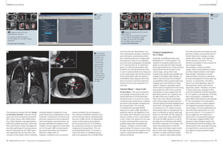 Clinical Lung Imaging Lung Imaging Clinical 
8B Protocol 
tree ‘AVM-Embolism’. 
8A 8B 
1 
4 2 3 
1 2 3 4 
10A 
6 7 8 
5 
9 
10A Sequence selection for the ‘Central 
Mass’ protocol. 
1: T1w VIBE, 2: T2w HASTE, 3: TrueFISP, 
4: T2w STIR, 5: T2w BLADE, 6: DWI, 
7: TWIST perfusion, 8: fl 3D ceMRA, 
9: T1w VIBE contrast enhanced 
In-room time 30 minutes 
8A Sequence selection for the 
‘AVM-Embolism’ protocol. 
1: TrueFISP, 2: TWIST perfusion, 
3: fl 3D ceMRA, 4: T1w VIBE contrast 
enhanced 
in-room time 15 minutes 
9A 9B ule during the day. Nevertheless, this 
The indications covered with the ‘Vessel 
or Perfusion Disorder’ protocol include 
acute and chronic pulmonary embolism 
(PE), arterio-venous (AV) malformation 
(e.g. Osler‘s disease), lung sequestration, 
pulmonary arterial aneurysm, abnormal-ities 
of pulmonary venous drainage and 
any other pathology of lung vasculature. 
Specific indications for the TWIST perfu-sion 
appreciate the fact that this is the 
only part of the protocol which indirectly 
9 Two cases of 
acute pulmonary 
embolism. On 
the left a case 
with massive 
embolism and 
large thrombi 
detected with 
the TrueFISP 
series, on the 
right a small 
embolus within 
a segmental ves-sel, 
in this case 
detected with 
the VIBE. 
short examination provides comprehen-sive 
information on pulmonary embo-lism 
combining perfusion imaging with 
the diagnostic scope of a scintigraphy 
and lung vessel angiography comparable 
to CT scanning (Fig. 9). An important 
point is to start the examination with 
TrueFISP non-contrast enhanced series. 
In case of severe embolism the diagnosis 
can be made within the first 60 seconds 
of the examination with the option to 
immediately stop imaging at that time 
and to proceed to intensive treatment 
without any time loss compared to CT 
scanning. 
‘Central Mass’ – have it all! 
‘Central Mass’ is the most comprehen-sive 
package of the protocol tree, con-taining 
elements of all the aforemen-tioned 
branches. It accounts for vessel 
involvement by central lung or mediasti-nal 
tumors with possible consequences 
for lung perfusion. This includes 
T2-weighted fat-saturated BLADE 
sequences as well as DWI. Typically, it 
would be used for the diagnosis of cen-tral 
masses with infiltration into the pul-monary 
arteries or aorta. ‘Central Mass’ 
is also a ‘have it all’ protocol for all cases 
in which one would like to cover any 
possible aspect with comprehensive 
imaging – however, since this takes 
approximately 30 minutes in-room-time, 
for daily routine and the majority of indi-cations 
it would be practicable to use 
selective protocols. 
10B 
Protocol adaptations 
for 3 Tesla 
Originally, lung MRI protocols were 
developed for 1.5 Tesla systems. The 
majority of available publications are 
based on work with this field strength. 
Since high performance 3 Tesla scanners 
have become the benchmark on the 
clinical stage, serious effort was 
invested into transferring lung MRI tech-nology 
to the higher field strength. Ini-tially, 
it was discussed that increased 
susceptibility artifacts would make lung 
imaging even more difficult on these 
systems. However, systematic experi-mental 
work and application fine tuning 
have paved the road to the successful 
introduction of lung imaging into the 
high field world [4, 5]. In general, pro-ton 
MRI of the lung is based on the 
effect that most relevant pathologies 
have intense signal and give optimum 
contrast against the black background of 
lung tissue. Consequently, transfer of 
the protocols to a 3T system has even 
improved the lesion to background con-trast 
in infiltrative as well as solid lung 
lesions for all FLASH and TSE sequence 
types. In particular, lung nodule detec-tion 
with the VIBE sequence as well as 
the detection of infiltrates with HASTE 
and STIR is improved on 3T images. This 
opens the perspective to invest the 
higher signal into higher spatial resolu-tion 
or even faster image acquisition 
schemes. Contrast-enhanced studies 
after i.v. injection reach equal quality 
visualizes defects or absence of lung 
parenchyma due to emphysema or pneu-mothorax. 
Furthermore, functional lung 
perfusion impairment due to hypoventi-lation 
and hypoxic vasoconstriction can 
be easily detected (air-trapping in bron-chiolitis, 
mucous impaction in cystic fibro-sis). 
At this point, MRI includes specific 
functional information that would be 
difficult to obtain with CT. 
However, conditions such as acute pul-monary 
embolism are an emergency. 
This requires immediate interaction and 
will not allow for typical scheduling lead 
times for an MR scanner. An abbreviated 
version of the protocol was prepared 
for this purpose (Fig. 8): It is limited to 
four sequences focusing on lung vessel 
imaging and lung perfusion. This can 
be accomplished within 15 minutes in-room- 
time which is considered accept-able 
to be squeezed into a full MR sched-and 
10B Protocol 
tree ‘Central 
Mass’. 
with optimized technology first pass 
perfusion studies can be performed in a 
similar fashion [6]. Changes of image 
quality with transfer of the aforemen-tioned 
sequence concept to 3T are 
therefore acceptable or even positive for 
most sequence types. 
The exception concerns TrueFISP 
images, which show significant motion-and 
flow-related artifacts at the higher 
field strength. Delineation of vessel 
walls and other structures is still good, 
but lesion/background contrast does not 
improve. In combination, the effects 
result in an inhomogeneous signal of 
the pulmonary artery trunk and the 
large lobar vessels. Therefore, exclusion 
of severe pulmonary embolism with a 
quick free breathing TrueFISP acquisition 
on a 3T system is not favorable. To fill this 
gap in the protocol, a respiration-trig-gered 
SPACE-STIR sequence was adjusted 
for the visualization of central pulmo-nary 
vessels without contrast injection. 
The triggered acquisition scheme pro-duces 
images of central mediastinal ves-sels 
with bright signal within 4-5 min 
and can be used on 1.5T as well as 3T. 
Due to triggering, the acquisition is 
robust even in uncooperative patients. 
The respiration-triggered SPACE-STIR 
sequence might therefore replace the 
free breathing TrueFISP throughout the 
whole protocol tree, although sensitivity 
and specificity for pulmonary emboli 
are subject to ongoing patient studies 
(Fig. 12). 
12 MAGNETOM Flash 1/2011 · www.siemens.com/magnetom-world MAGNETOM Flash · 1/2011 · www.siemens.com/magnetom-world 13 
 