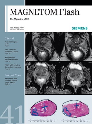 MAGNETOM Flash
      The Magazine of MR



      Issue Number 2 /2009
      ASTRO/ESTRO Edition




Clinical
Prostate Imaging
at 3T
Page 6

IVIM f-maps of
Pancreatic Lesions
Page 26

Nonsecretory
Multiple Myeloma
Page 34

TWIST MRA of Pelvic
Congestion Syndrome
Page 58



Product News
What’s new with
software version
syngo MR B17
Page 92




                             Xxxxxxx xxxxxxxxx xxxxxxxxxxxxxx
 