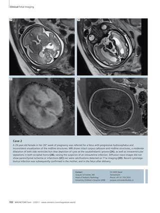 Clinical Fetal Imaging 
102 MAGNETOM Flash · 2/2011 · www.siemens.com/magnetom-world 
2B 
Case 2 
A 29-year-old female in her 26th week of pregnancy was referred for a fetus with progressive hydrocephalus and 
inconsistent visualization of the midline structures. MRI shows intact corpus callosum and midline structures, a moderate 
dilatation of both side ventricles but clear depiction of cysts at the caudothalamic groove (2A), as well as intraventricular 
septations in both occipital horns (2B), raising the suspicion of an intrauterine infection. Diffusion trace images did not 
show parenchymal ischemia or infarctions (2C) nor were calcifications detected on T1w imaging (2D). Recent cytomega-lovirus 
infection was subsequently confirmed in the mother, and in the fetus after delivery. 
Contact 
Jacques Schneider, MD 
Head of Pediatric Radiology 
University Children’s Hospital UKBB 
CH-4005 Basel 
Switzerland 
Phone +41 61 704 2632 
jacques.schneider@ukbb.ch 
308 % 
209 % 
2A 
2C 2D 
 