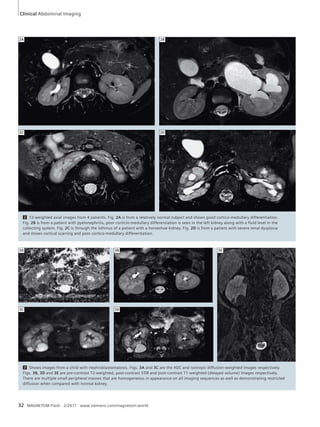 Clinical Abdominal Imaging 
2A 2B 
2C 2D 
2 T2-weighted axial images from 4 patients. Fig. 2A is from a relatively normal subject and shows good cortico-medullary differentiation. 
Fig. 2B is from a patient with pyelonephritis, poor corticio-medullary differentiation is seen in the left kidney along with a fluid level in the 
collecting system. Fig. 2C is through the isthmus of a patient with a horseshoe kidney. Fig. 2D is from a patient with severe renal dysplasia 
and shows cortical scarring and poor cortico-medullary differentiation. 
3B 3E 
3D 
3A 
3C 
3 Shows images from a child with nephroblastomatosis. Figs. 3A and 3C are the ADC and isotropic diffusion-weighted images respectively. 
Figs. 3B, 3D and 3E are pre-contrast T2-weighted, post-contrast STIR and post-contrast T1-weighted (delayed volume) images respectively. 
There are multiple small peripheral masses that are homogeneous in appearance on all imaging sequences as well as demonstrating restricted 
diffusion when compared with normal kidney. 
32 MAGNETOM Flash · 2/2011 · www.siemens.com/magnetom-world 
 