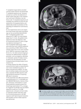 T1-weighted images before and after 
contrast media injection are performed. 
T1-weighted sequences pre- and post-contrast 
are used for the detection of 
lymph nodes especially in the mediasti-num 
and tumor infiltration into the 
thorax wall. T2-weighted sequences are 
nowadays the method of choice for the 
assessment of lung parenchyma, and 
additionally enable visualization of the 
pathology of mediastinum and thoracic 
wall. 
Ex vivo experiments and in vivo experi-ence 
have shown that solid lung pathol-ogy 
can be successfully detected with 
fast T1-weighted gradient echo 
sequences (T1-GRE). For lung nodules 
larger than 4–5 mm, 3D gradient echo 
sequences reach the detection rates 
of conventional helical CT with a single 
row detector technique [11]. 
The T2-weighted ‘Half-Fourier single-shot 
turbo spin-echo’ (HASTE) sequence 
has a sensitivity of 85%–90% for lung 
nodules larger than 4 mm and a sensitiv-ity 
of 100% for lung lesions larger than 
8 mm [12, 13]. Post-contrast imaging is 
necessary for differentiation of pleural 
processes, such as empyema, abscesses 
or metastatic spread of malign tumors, 
as well as for the evaluation of solid 
intraparenchymal benign/malign tumor 
masses [12]. 
In airways disease the reflex of hypoxic 
vasoconstriction leads to impaired perfu-sion 
in less ventilated lung areas. To 
detect lung perfusion defects, an injec-tion 
of contrast media at the same time 
that a repeated 3D GRE sequence with 
high temporal resolution is acquiring 
MRI data is necessary. 
In the presented case, MRI examinations 
were performed on a 1.5 Tesla MR scan-ner 
(MAGNETOM Avanto, Siemens Erlan-gen, 
Germany). Orientated on a previ-ously 
published standard protocol for 
lung image examination [11], a naviga-tor 
triggered T2w BLADE and T2w HASTE 
sequence as well as a T1w VIBE 
sequence pre- and post-contrast media 
in inspiratory breath hold were used. 
For functional assessment a 3D GRE 
sequence with high temporal resolution 
with parallel contrast media injection 
was performed. 
3A 
3B 
2 
2 
2 
1 
1 
1 
3 
3 
3 First follow-up MRI: axial T2-weighted HASTE (3A), syngo BLADE (3B) 
and T1-weighted VIBE image post contrast (3C): progressive pleural effusion 
on the right side (1) and unchanged right lower lobe consolidation with 
abscesses (2). Bronchial wall thickening is visible in the left lower lobe (3). 
MAGNETOM Flash · 2/2011 · www.siemens.com/magnetom-world 77 
3C 
 