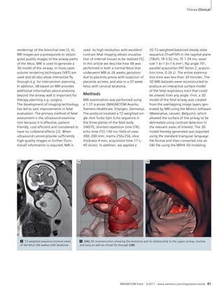 Thorax Clinical 
used. Its high-resolution with excellent 
contrast fetal imaging allows visualiza-tion 
of internal tissues to be realized [5]. 
In this article we describe how VB was 
performed in both a normal fetus that 
underwent MRI at 28 weeks gestation 
due to placenta previa with suspicion of 
placenta accreta, and also in a 37 week 
fetus with cervical teratoma. 
Methods 
MRI examination was performed using 
a 1.5T scanner (MAGNETOM Avanto, 
Siemens Healthcare, Erlangen, Germany). 
The protocol involved a T2-weighted sin-gle 
shot Turbo Spin Echo sequence in 
the three planes of the fetal body 
(HASTE; shortest repetition time (TR); 
echo time (TE) 140 ms; field-of-view 
300–200 mm; matrix 256×256; slice 
thickness 4 mm; acquisition time 17 s; 
40 slices). In addition, we applied a 
3D T2-weighted balanced steady state 
sequence (TrueFISP) in the sagittal plane 
(TRUFI; TR 3.02 ms; TE 1.34 ms; voxel 
size 1.6×1.6×1.6 mm3; flip angle 70°; 
parallel acquisition PAT factor 2; acquisi-tion 
time, 0.26 s). The entire examina-tion 
time was less than 20 minutes. The 
3D MRI datasets were reconstructed to 
produce an interactive surface model 
of the fetal respiratory tract that could 
be viewed from any angle. First, a 3D 
model of the fetal airway was created 
from the overlapping image layers gen-erated 
by MRI using the Mimics software 
(Materialise, Leuven, Belgium), which 
allowed the surface of the airway to be 
delineated using contrast detection in 
the relevant areas of interest. The 3D 
model thereby generated was exported 
using the standard triangular language 
file format and then converted into an 
OBJ file using the MAYA 3D modeling 
2 3A 3B 
MAGNETOM Flash · 2/2011 · www.siemens.com/magnetom-world 81 
renderings of the bronchial tree [3, 4]. 
MR images are a prerequisite to obtain 
good quality images of the airway paths 
of the fetus. MRI is used to generate a 
3D model of the airway; in most cases 
volume rendering techniques (VRT) are 
used and do also allow interactive fly 
through e.g. for intervention planning. 
In addition, VB based on MRI provides 
additional information about anatomy 
beyond the airway wall is important for 
therapy planning e.g. surgery. 
The development of imaging technology 
has led to vast improvements in fetal 
evaluation. The primary method of fetal 
assessment is the ultrasound examina-tion 
because it is effective, patient-friendly, 
cost-efficient and considered to 
have no collateral effects [2]. When 
ultrasound cannot provide sufficiently 
high-quality images or further (func-tional) 
information is required, MRI is 
2 T2-weighted sequence (coronal view) 
of the fetus (28 weeks) with teratoma. 
3 (3A) 3D reconstruction showing the teratoma and its relationship to the upper airway, trachea 
and lung as well as virtual fly-through (3B). 
 