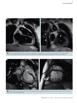 Cardiology Clinical 
1B Coronal black-blood HASTE images show the typical ‘piggyback’ configuration of the ventricles with the smaller right ventricle situated 
superior to the dilated left ventricle. Arrow points to a large ventricular septal defect (VSD). Arrowheads point to the tunneled Fontan. 
1C Single frames from long axis and short axis cine images again show smaller RV situated superior to the larger LV. Again, note the Ao arising 
from the RV, and the large VSD (arrow). 
MAGNETOM Flash · 2/2011 · www.siemens.com/magnetom-world 87 
1B 
1C 
Ao 
RV 
LV 
Ao 
LV 
Ao 
RV 
LV 
RV 
LV 
 