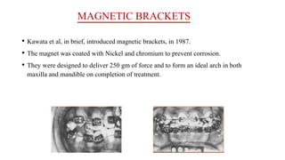 MAGNETIC BRACKETS
• Kawata et al, in brief, introduced magnetic brackets, in 1987.
• The magnet was coated with Nickel and chromium to prevent corrosion.
• They were designed to deliver 250 gm of force and to form an ideal arch in both
maxilla and mandible on completion of treatment.
 
