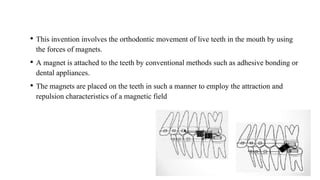 • This invention involves the orthodontic movement of live teeth in the mouth by using
the forces of magnets.
• A magnet is attached to the teeth by conventional methods such as adhesive bonding or
dental appliances.
• The magnets are placed on the teeth in such a manner to employ the attraction and
repulsion characteristics of a magnetic field
 