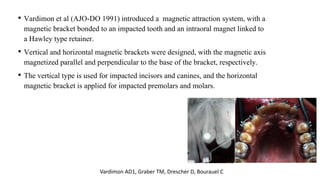 • Vardimon et al (AJO-DO 1991) introduced a magnetic attraction system, with a
magnetic bracket bonded to an impacted tooth and an intraoral magnet linked to
a Hawley type retainer.
• Vertical and horizontal magnetic brackets were designed, with the magnetic axis
magnetized parallel and perpendicular to the base of the bracket, respectively.
• The vertical type is used for impacted incisors and canines, and the horizontal
magnetic bracket is applied for impacted premolars and molars.
Vardimon AD1, Graber TM, Drescher D, Bourauel C
 