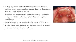 • In deep impaction, the Nd2Fe14B magnetic bracket was cold-
sterilized before surgery, and the surgical flap was then sutured
over the bonded magnetic bracket.
• Attraction was initiated 1 to 2 weeks after healing. Thus tooth
emergence into the oral cavity replicated normal eruption
conditioning.
• The system operated at an attractive force level of 0.2 to 0.5 N.
• No side effects were observed in a restricted number of treated
cases, and treatment time was reduced.
Vardimon AD1, Graber TM, Drescher D, Bourauel C
 