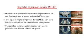 • Darendeliler et al examined the effect of magnetic forces for
maxillary expansion in human patients of different ages.
• Two types of magnetic expansion device (MED) were used,
bonded in two patients and banded in four other patients.
• Two repelling samarium-cobalt magnets were used to
generate forces between 250 and 500 grams.
magnetic expansion device (MED)
 