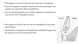 • The magnets were fixed in the root with a thin layer of composite.
• The use of magnets to extrude a traumatised incisor and enhance root
eruption was reported by McCord and Harvie.
• The case report detailed the use of SmCo magnets to extrude the root
of an incisor with a subgingival fracture.
• One magnet was fixed to the root and one embedded in a removable
partial denture.
• Bondemark et al.reported a similar protocol with NdFeB magnets for
the extrusion of crown-root fractured teeth.
 