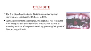 OPEN BITE
• The first clinical application in this field, the Active Vertical
Corrector, was introduced by Dellinger in 1986.
• Bearing posterior repelling magnets, this appliance was considered
as an 'energized' bite block removable or fixed, with the aim of
achieving intrusion of the posterior teeth by generating 700 grams of
force per magnetic unit.
 