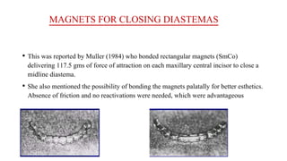 MAGNETS FOR CLOSING DIASTEMAS
• This was reported by Muller (1984) who bonded rectangular magnets (SmCo)
delivering 117.5 gms of force of attraction on each maxillary central incisor to close a
midline diastema.
• She also mentioned the possibility of bonding the magnets palatally for better esthetics.
Absence of friction and no reactivations were needed, which were advantageous
 