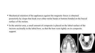 • Mechanical retention of the appliances against the magnetic forces is obtained
posteriorly by clasps that hook over either molar bands or buttons bonded on the buccal
surface of the molars.
• In the anterior area, a small amount of composite is placed on the labial surface of the
incisors occlusally to the labial bow, so that the bow rests tightly on its composite
support.
 