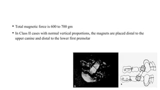 • Total magnetic force is 600 to 700 gm
• In Class II cases with normal vertical proportions, the magnets are placed distal to the
upper canine and distal to the lower first premolar
 
