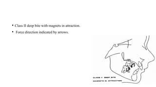 • Class II deep bite with magnets in attraction.
• Force direction indicated by arrows.
 