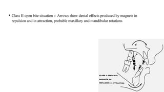 • Class II open bite situation :- Arrows show dental effects produced by magnets in
repulsion and in attraction, probable maxillary and mandibular rotations
 