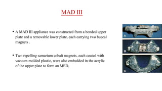 MAD III
• A MAD III appliance was constructed from a bonded upper
plate and a removable lower plate, each carrying two buccal
magnets .
• Two repelling samarium cobalt magnets, each coated with
vacuum-molded plastic, were also embedded in the acrylic
of the upper plate to form an MED.
 